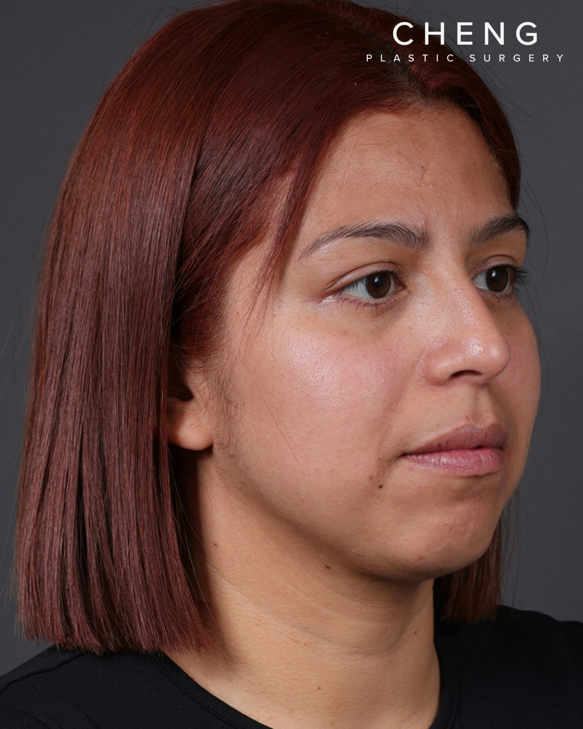 Fat Grafting Before & After Gallery - Patient 397263 - Image 4