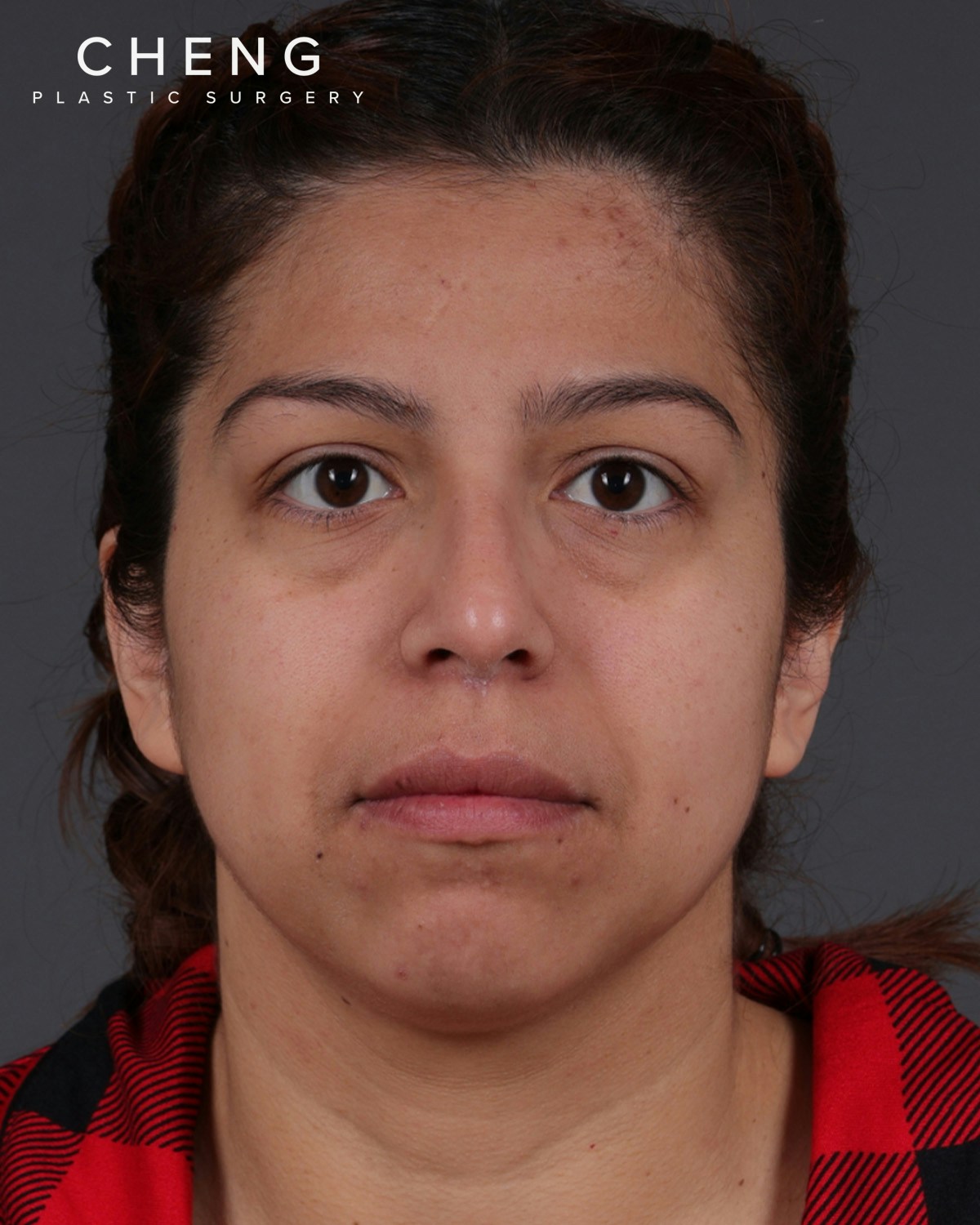 Fat Grafting Before & After Gallery - Patient 397263 - Image 1