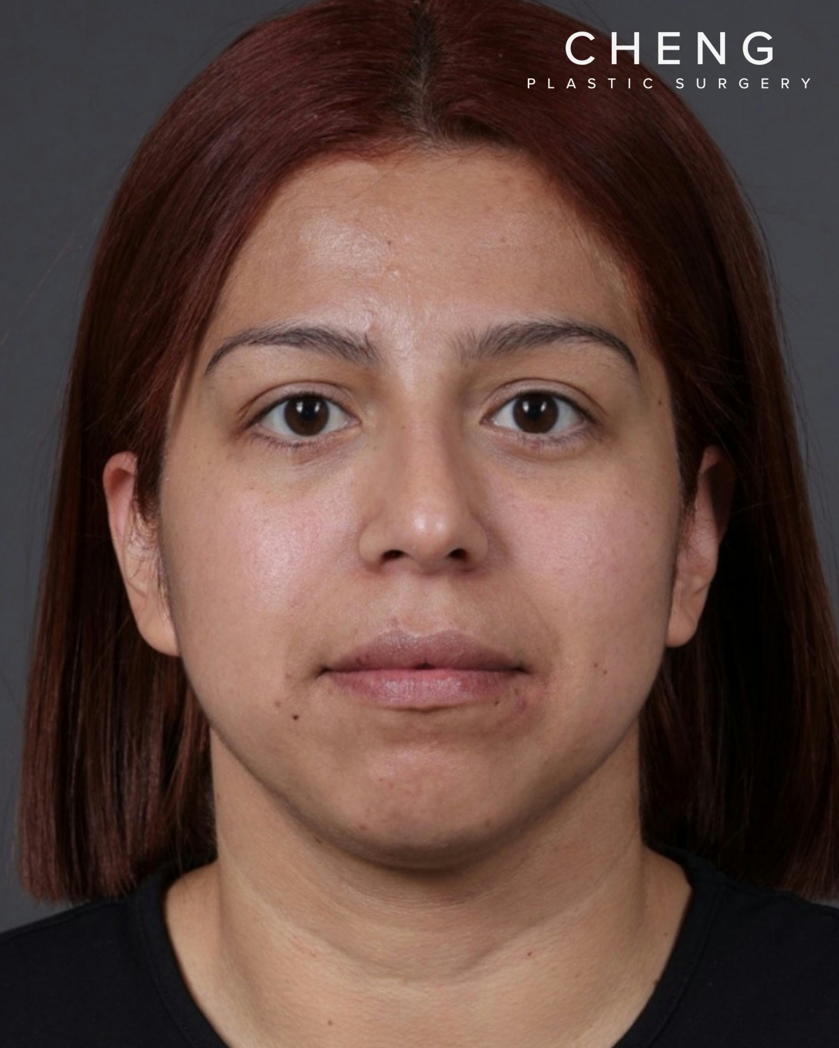 Fat Grafting Before & After Gallery - Patient 397263 - Image 2