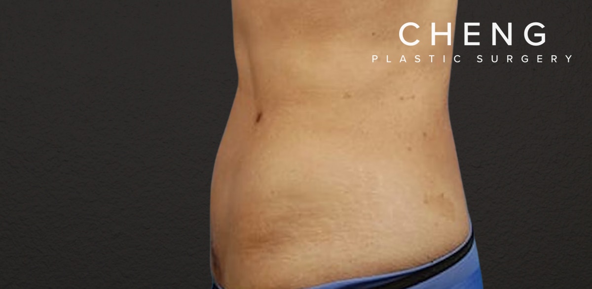 Liposuction Before & After Gallery - Patient 330875 - Image 2