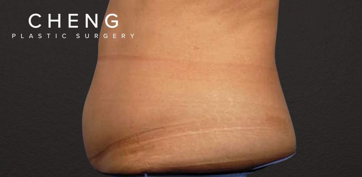 Liposuction Before & After Gallery - Patient 330875 - Image 1