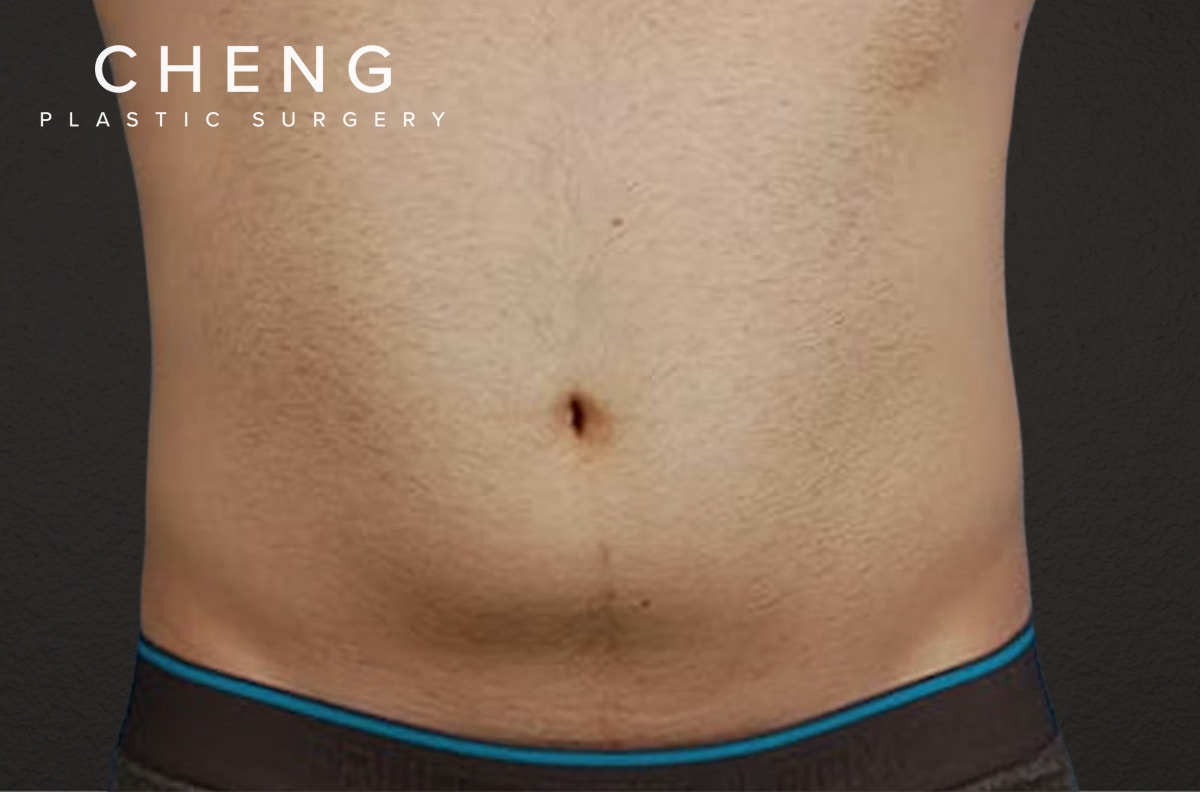 Liposuction Before & After Gallery - Patient 333626 - Image 1