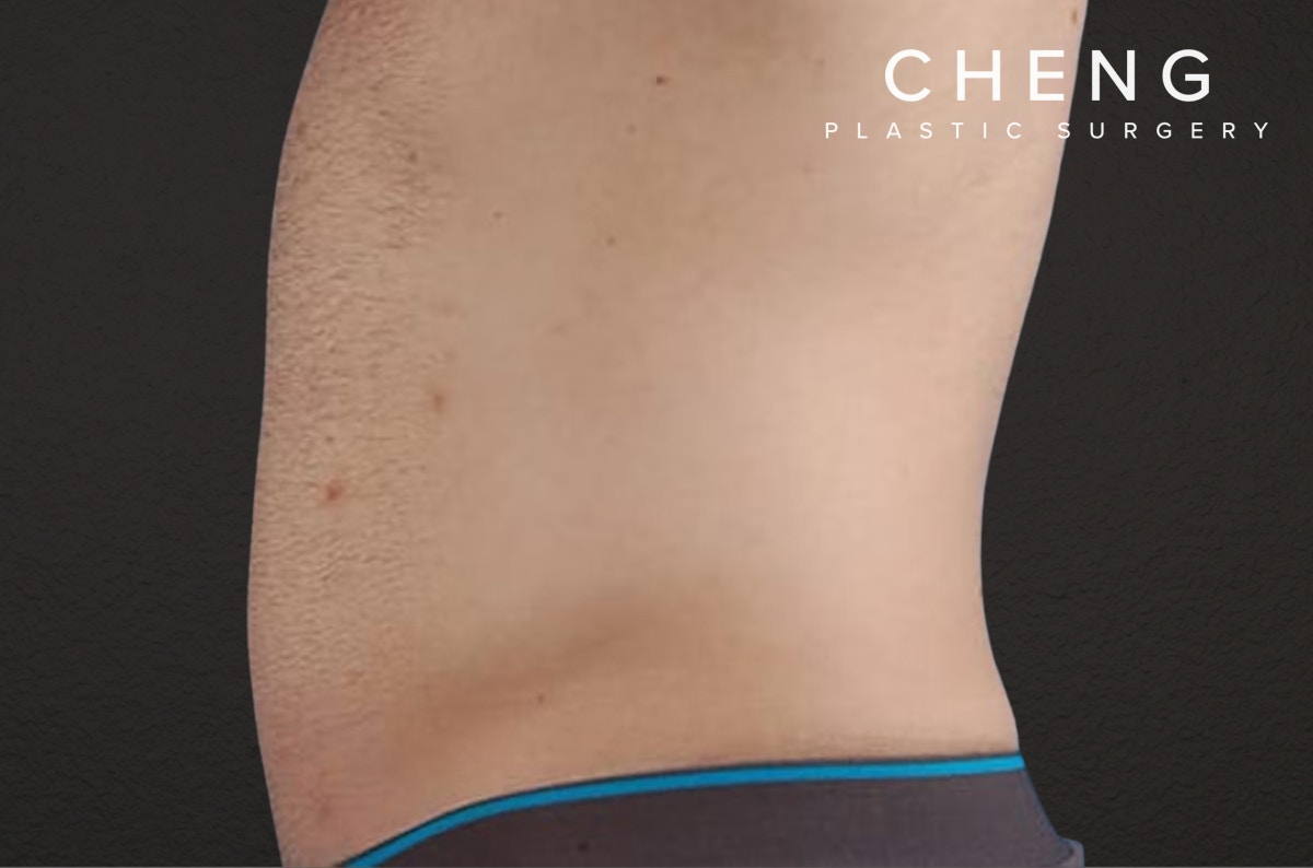 Liposuction Before & After Gallery - Patient 333626 - Image 4