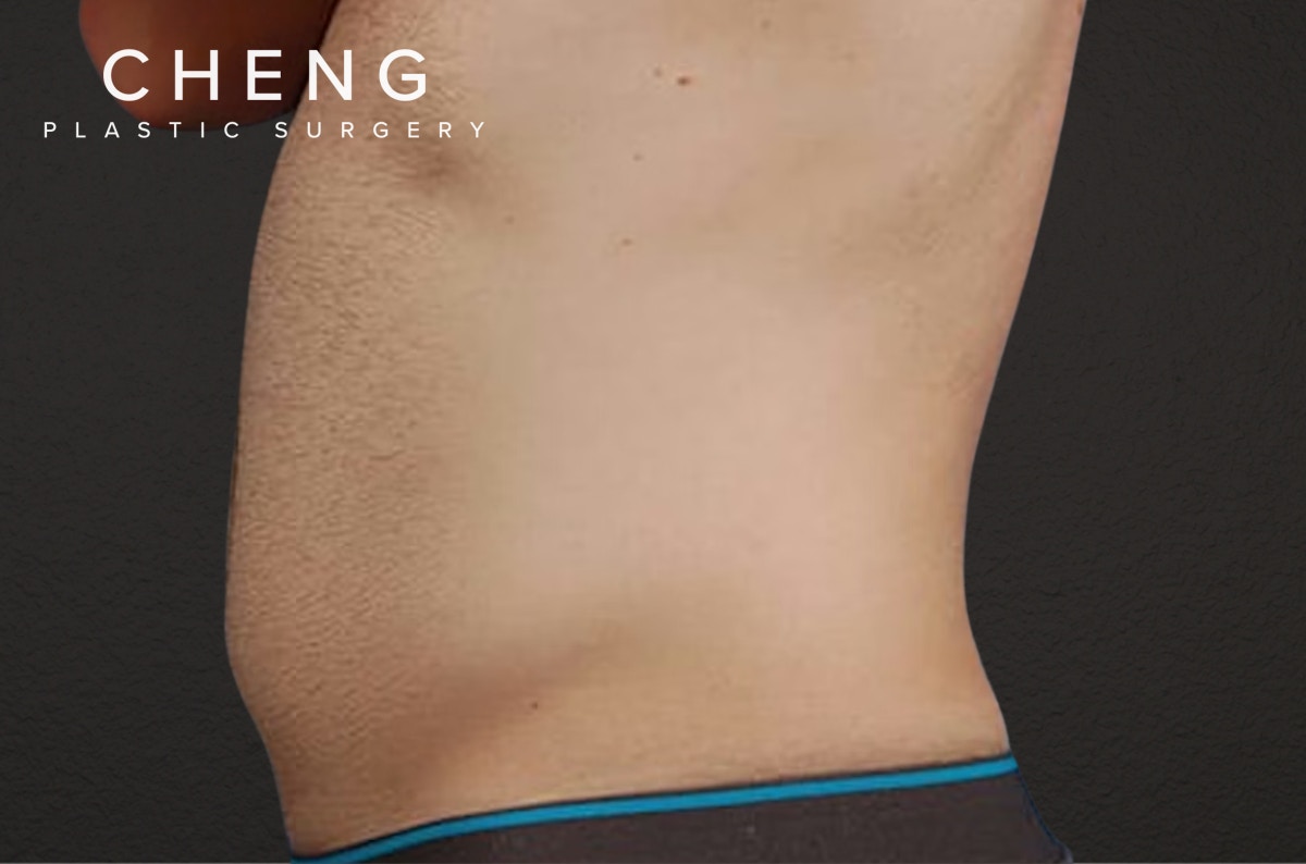 Liposuction Before & After Gallery - Patient 333626 - Image 3