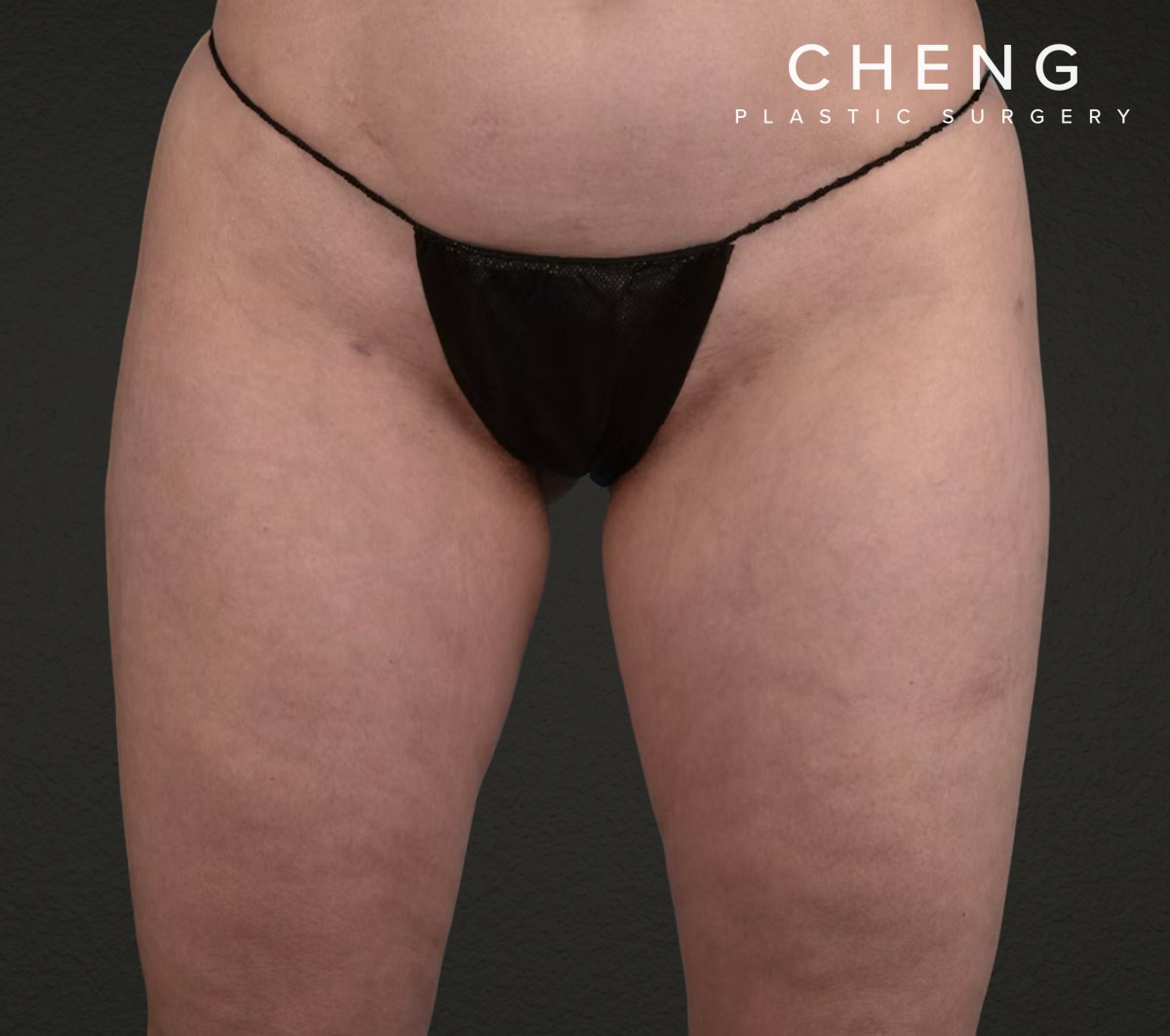Liposuction Before & After Gallery - Patient 464332 - Image 2