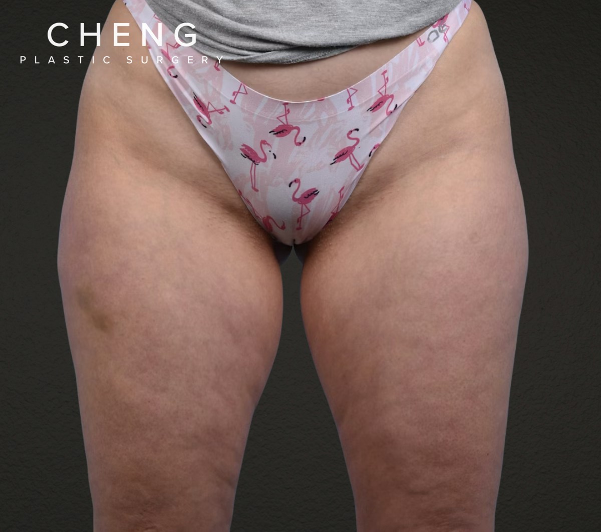 Liposuction Before & After Gallery - Patient 464332 - Image 1