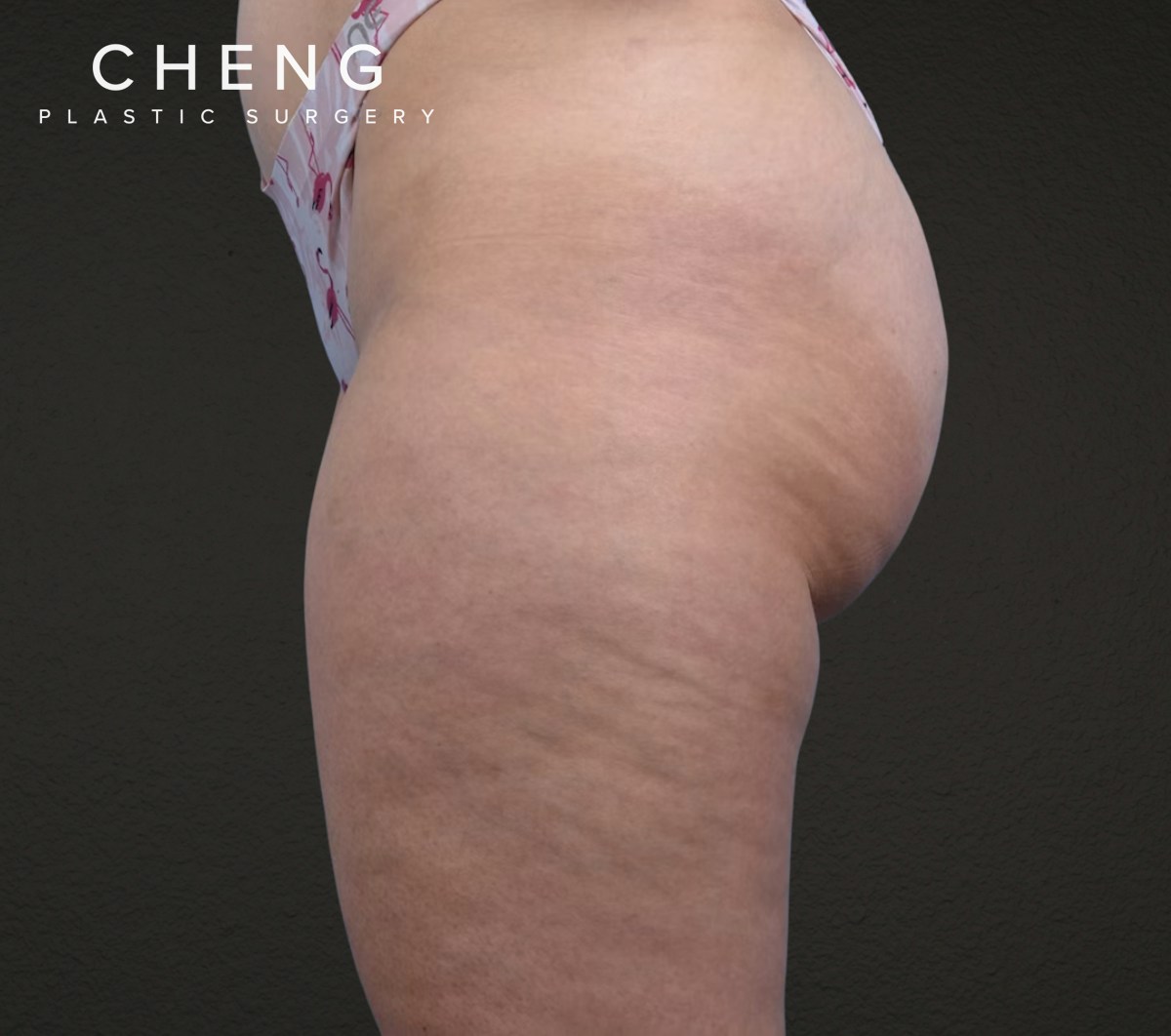Liposuction Before & After Gallery - Patient 464332 - Image 3