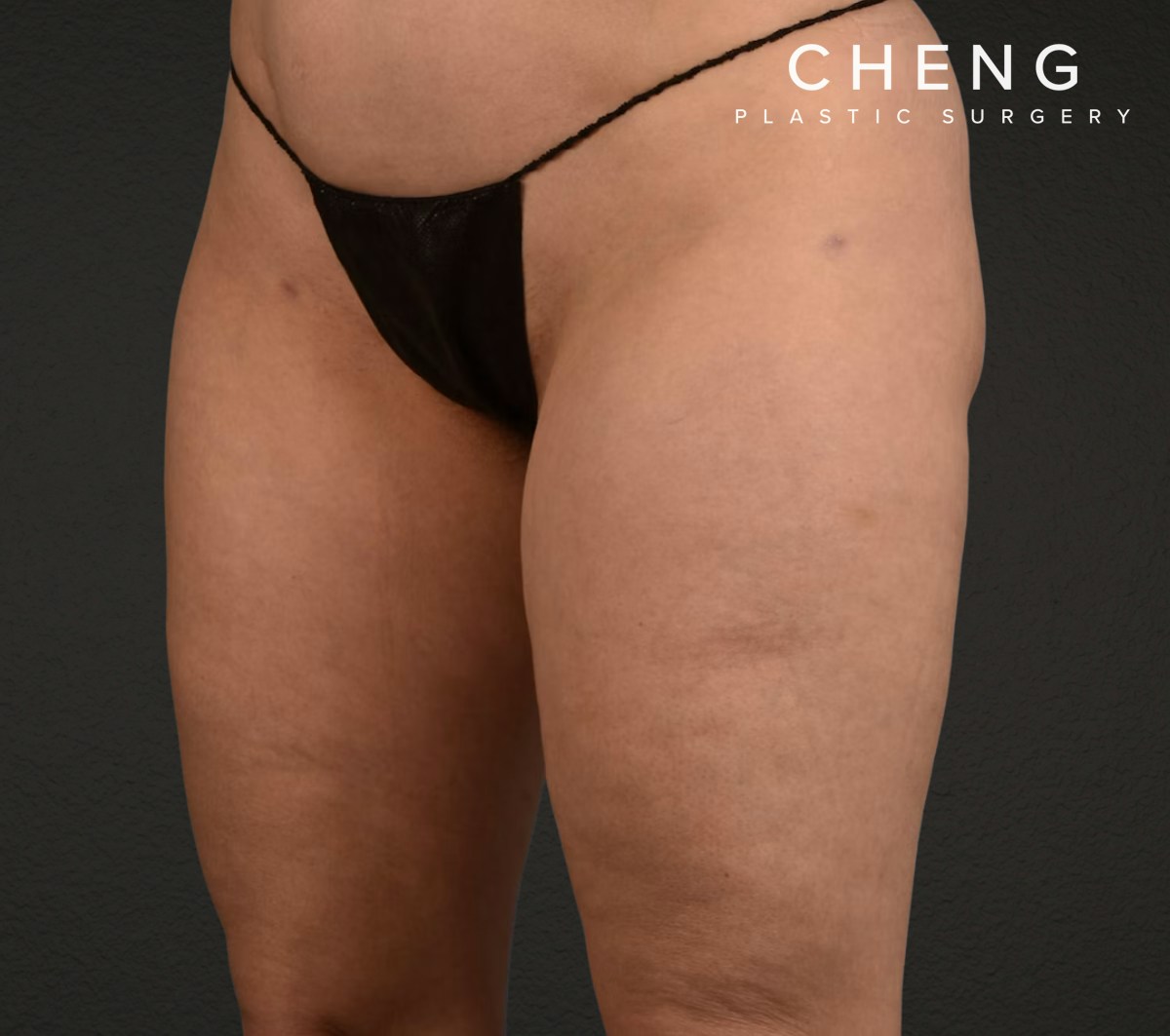 Liposuction Before & After Gallery - Patient 464332 - Image 6