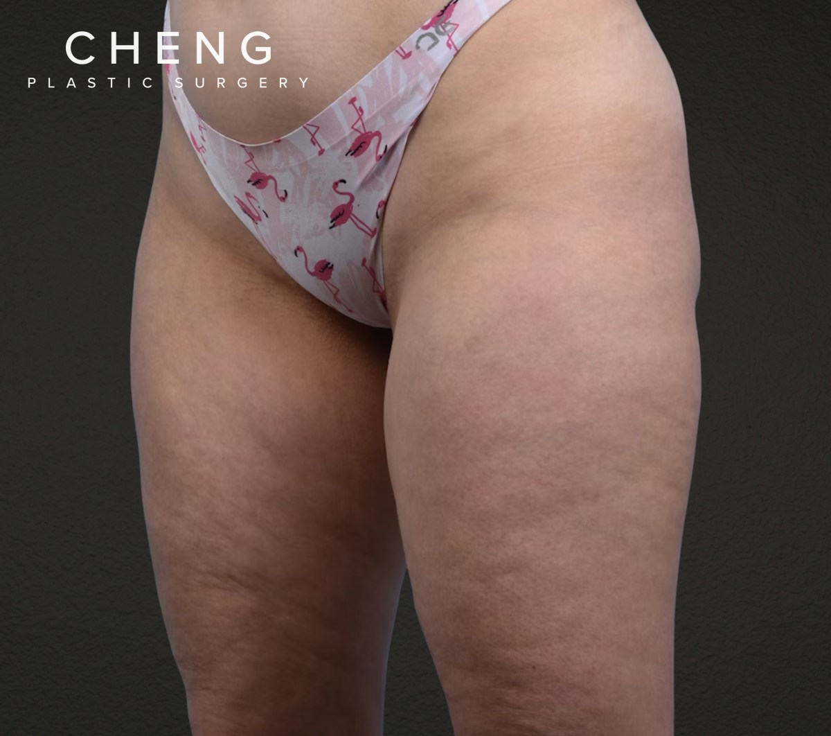 Liposuction Before & After Gallery - Patient 464332 - Image 5
