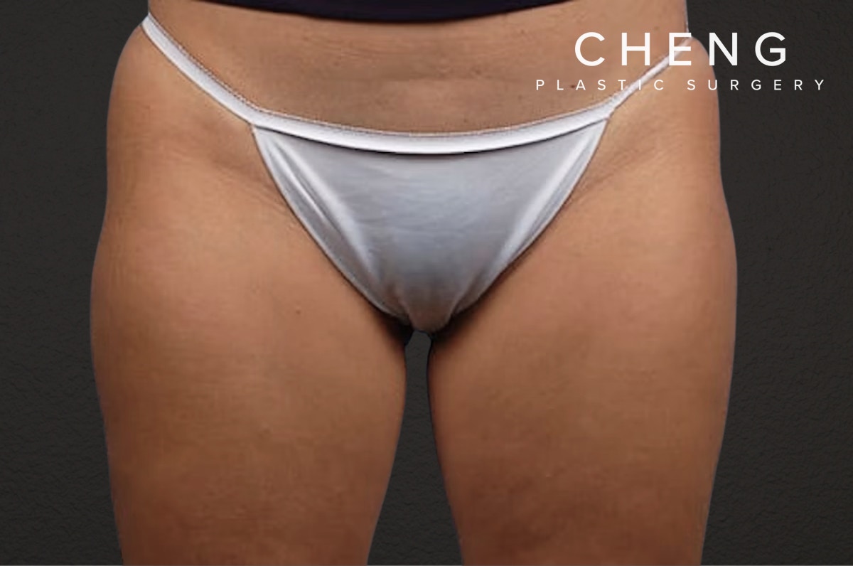 Liposuction Before & After Gallery - Patient 303157 - Image 2