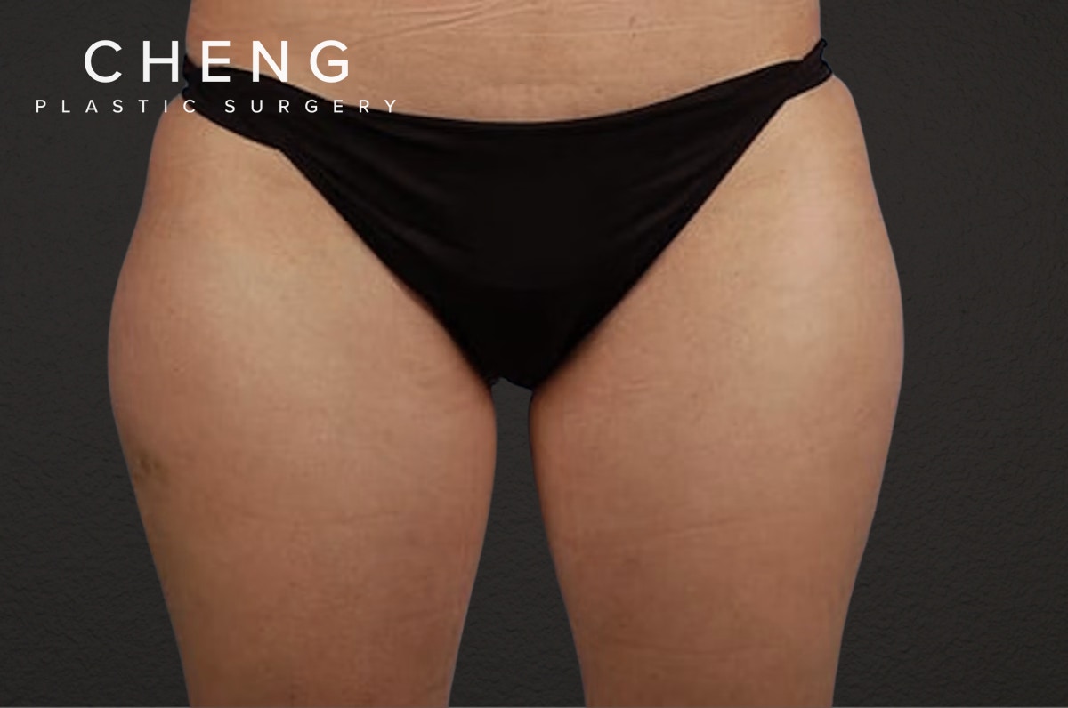 Liposuction Before & After Gallery - Patient 303157 - Image 1