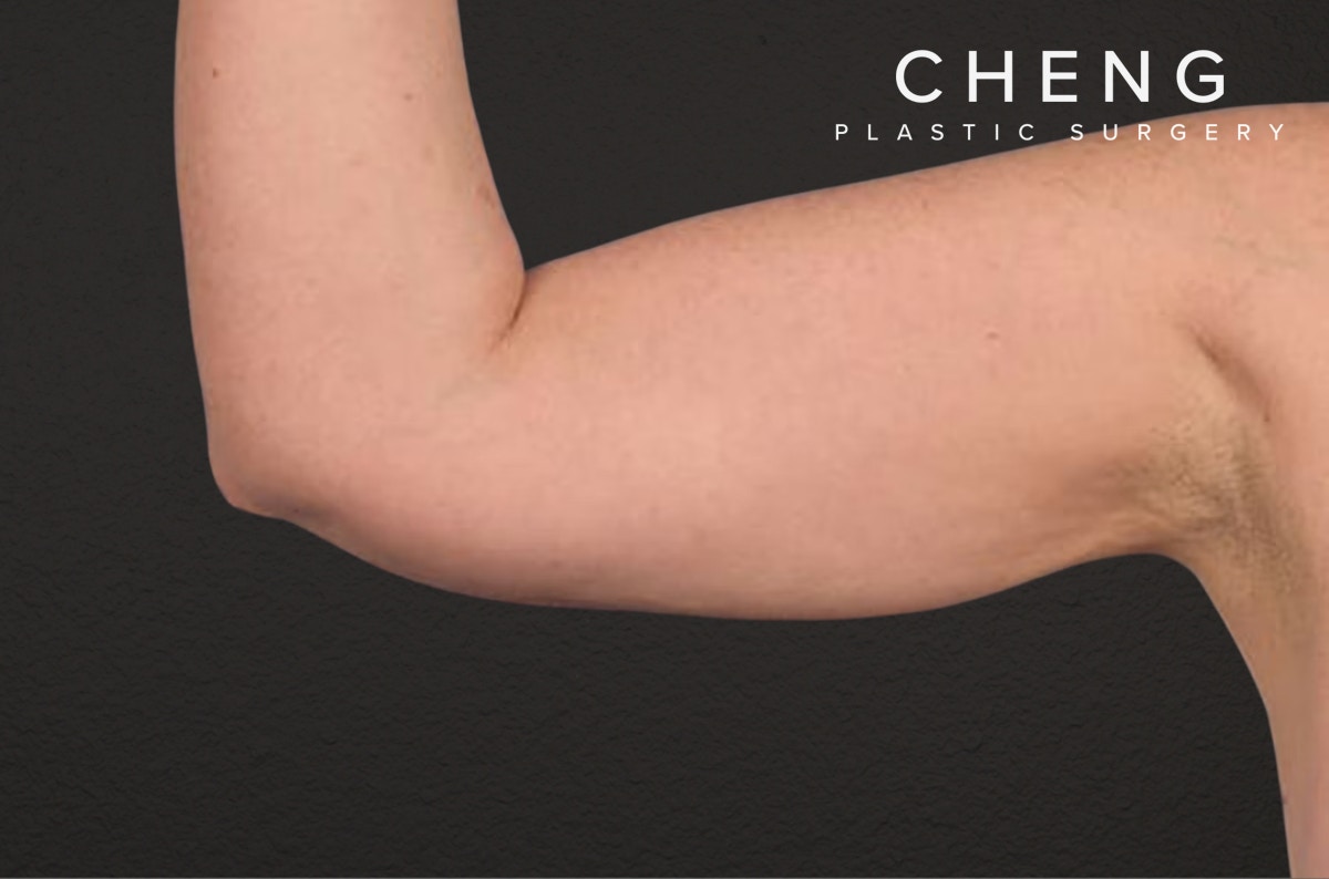 Liposuction Before & After Gallery - Patient 329177 - Image 2
