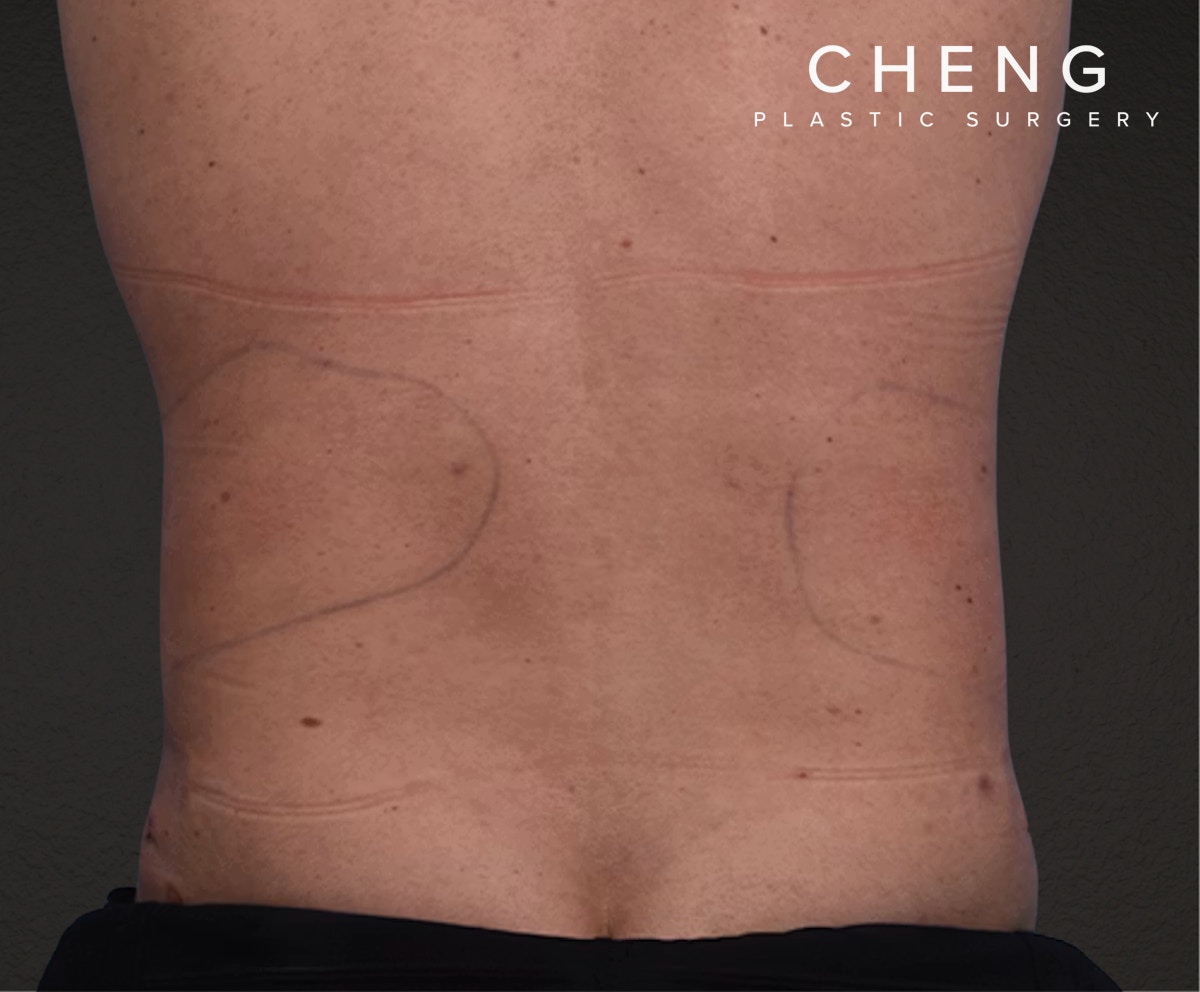 Liposuction Before & After Gallery - Patient 267185 - Image 8