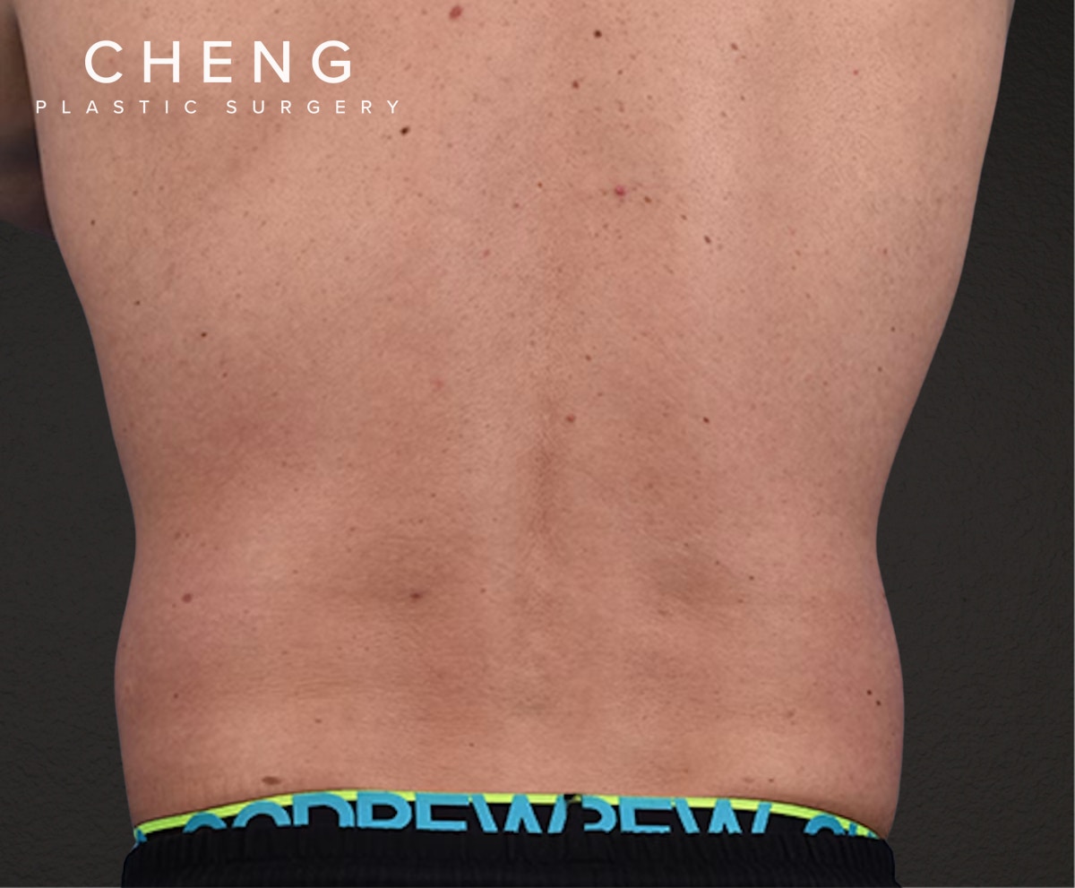 Liposuction Before & After Gallery - Patient 267185 - Image 7