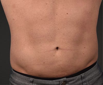 Liposuction Before & After Gallery - Patient 267185 - Image 2