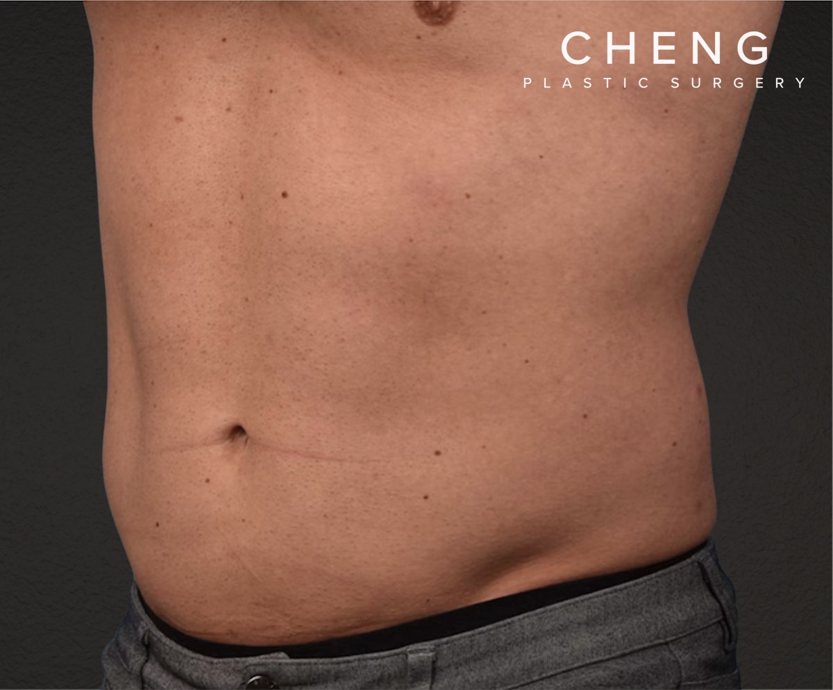 Liposuction Before & After Gallery - Patient 267185 - Image 4