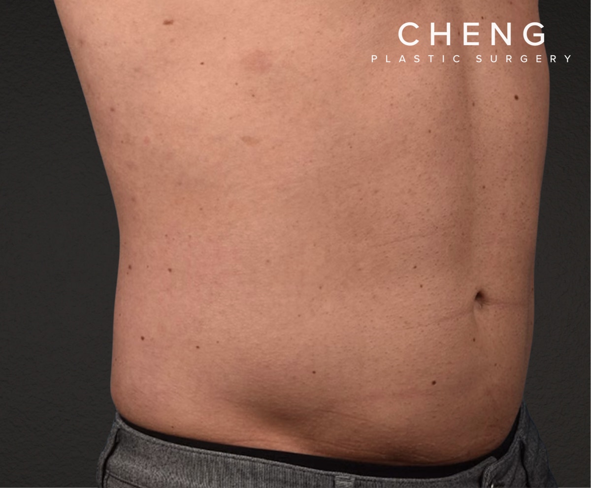 Liposuction Before & After Gallery - Patient 267185 - Image 6