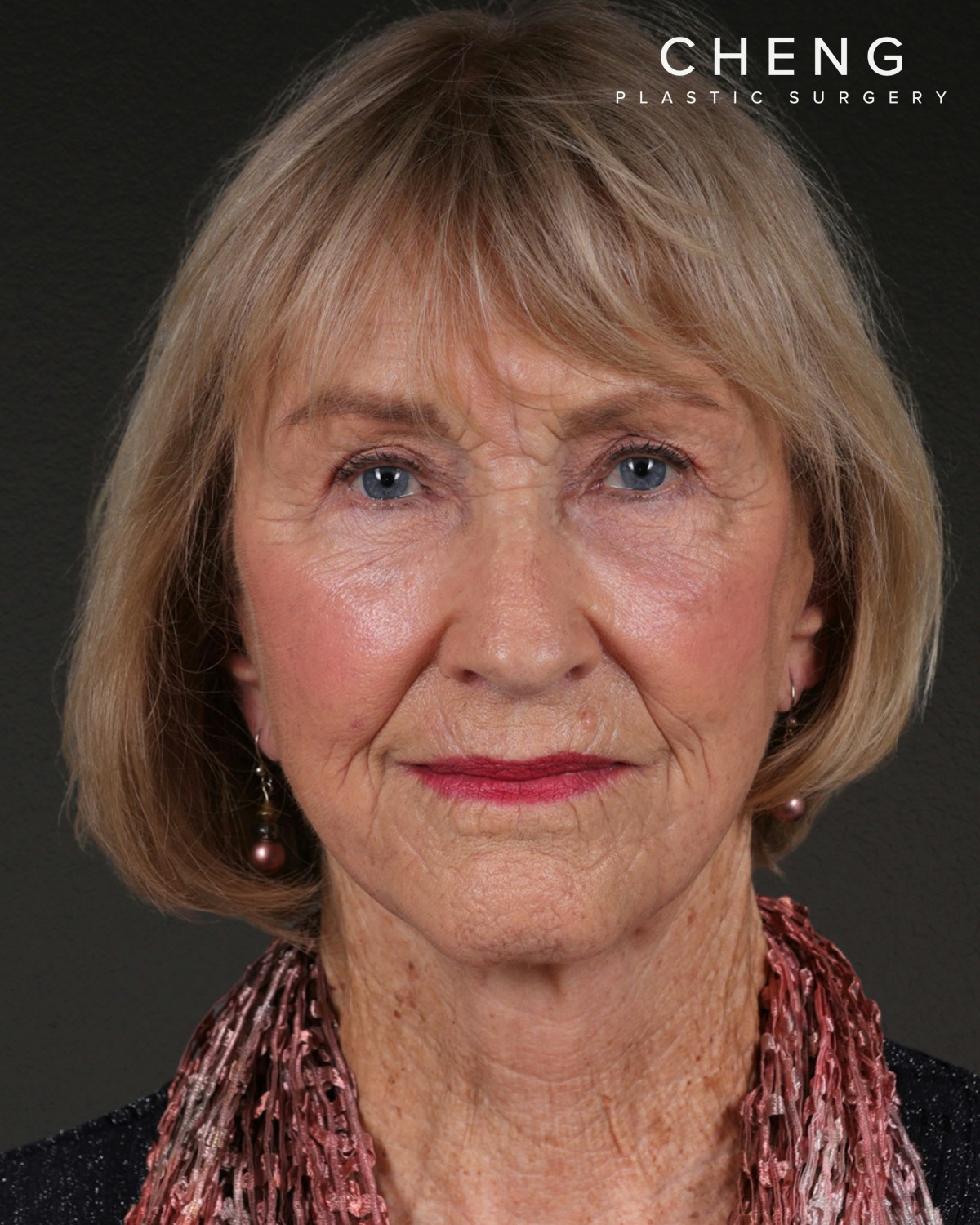 Neck Lift Before & After Gallery - Patient 244408 - Image 4