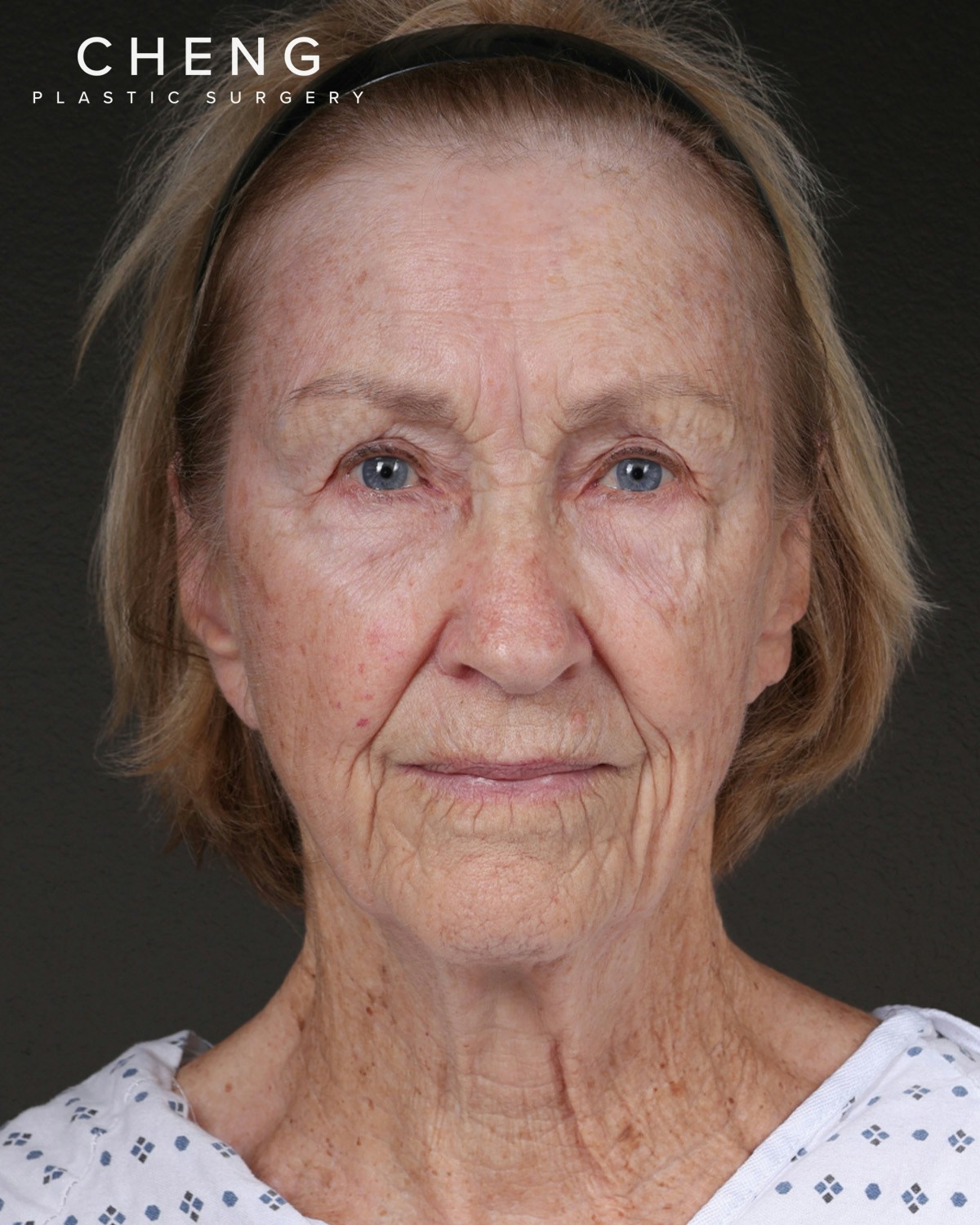 Neck Lift Before & After Gallery - Patient 244408 - Image 3