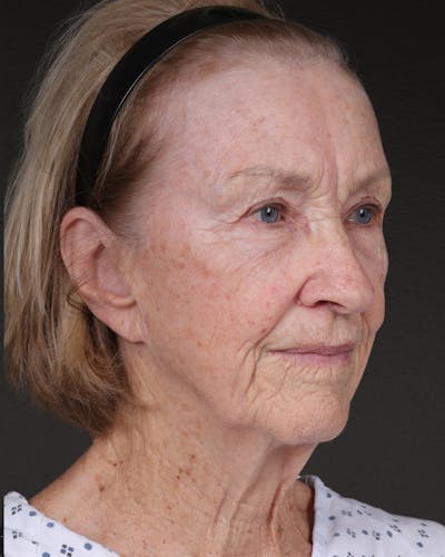 Fat Grafting Before & After Gallery - Patient 351077 - Image 1