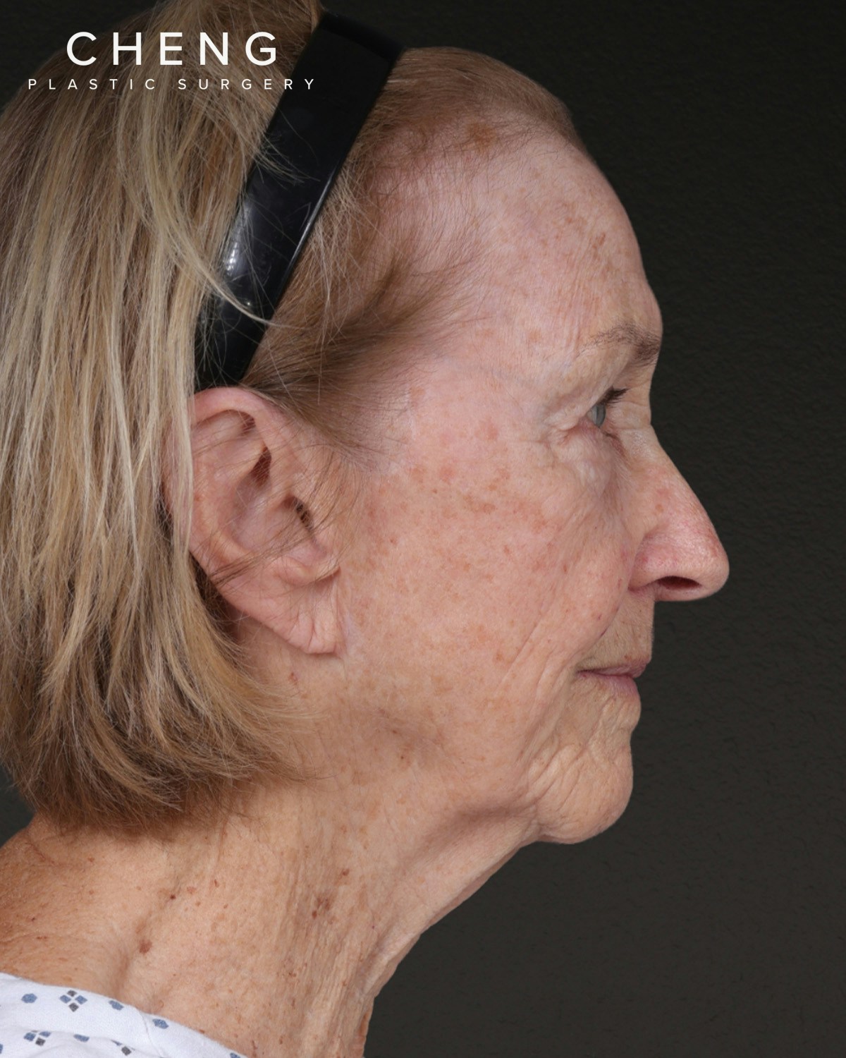 Neck Lift Before & After Gallery - Patient 244408 - Image 5