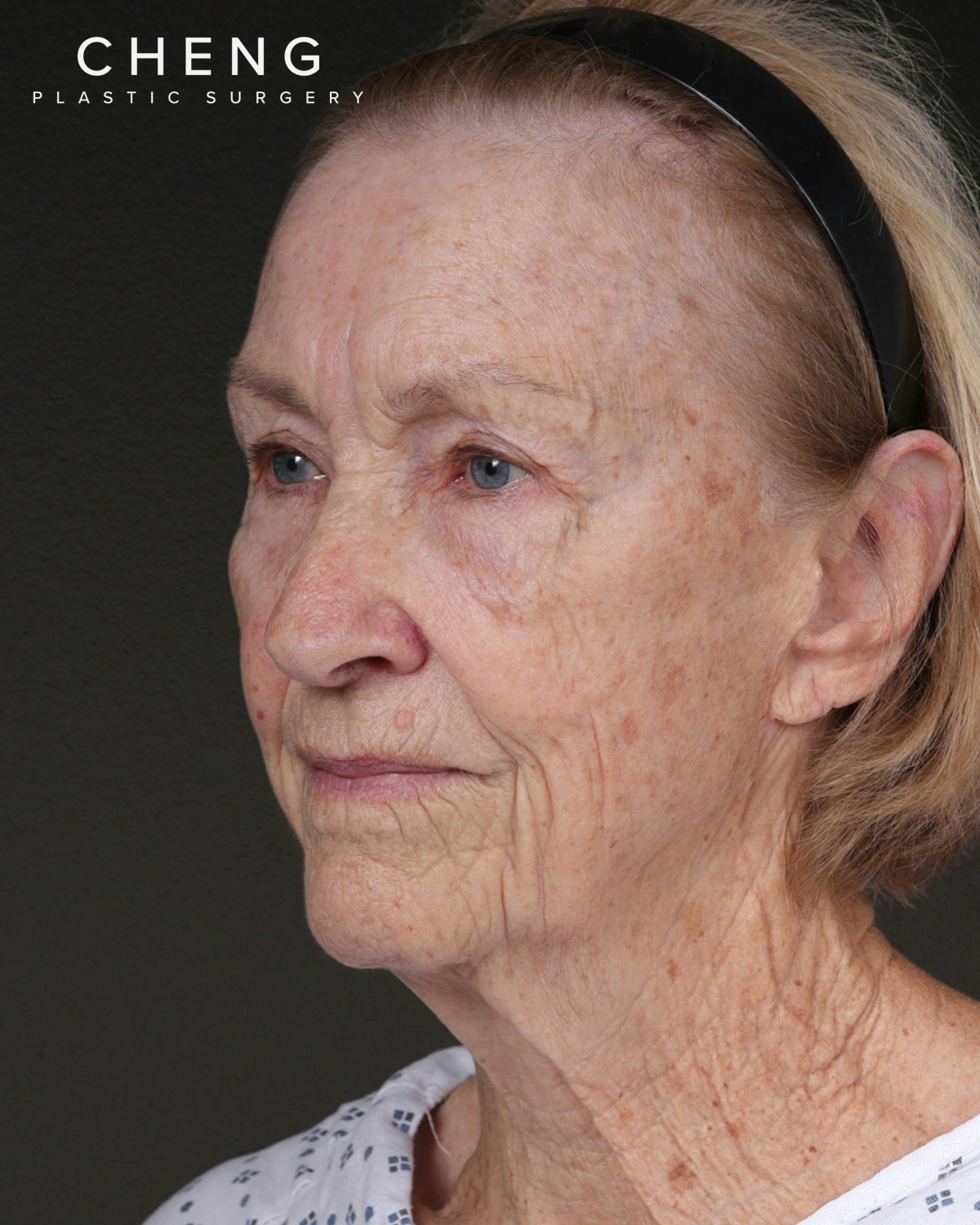 Neck Lift Before & After Gallery - Patient 244408 - Image 7