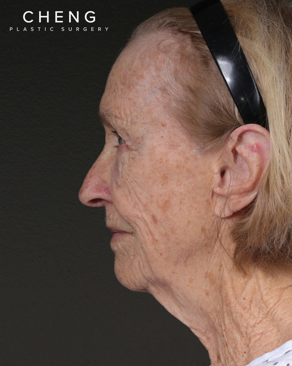 Neck Lift Before & After Gallery - Patient 244408 - Image 9