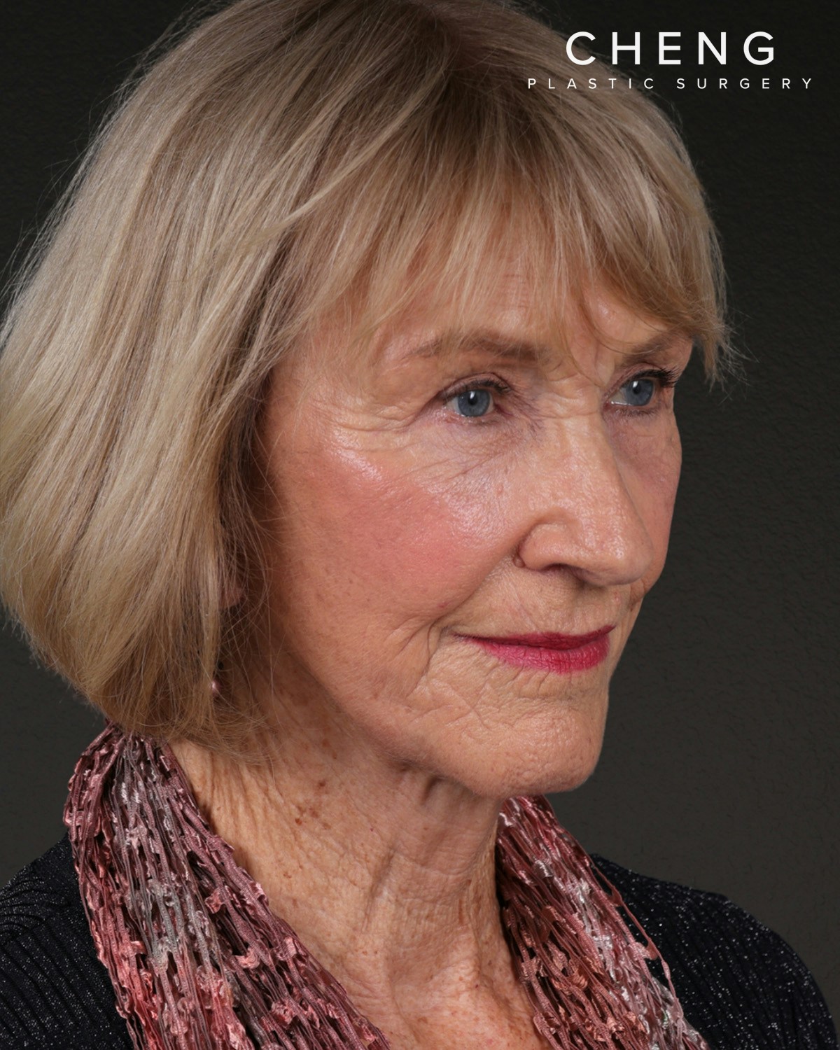Neck Lift Before & After Gallery - Patient 244408 - Image 2