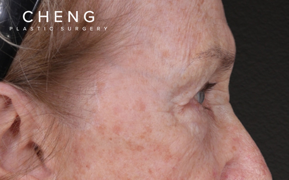 Blepharoplasty Before & After Gallery - Patient 162903 - Image 5