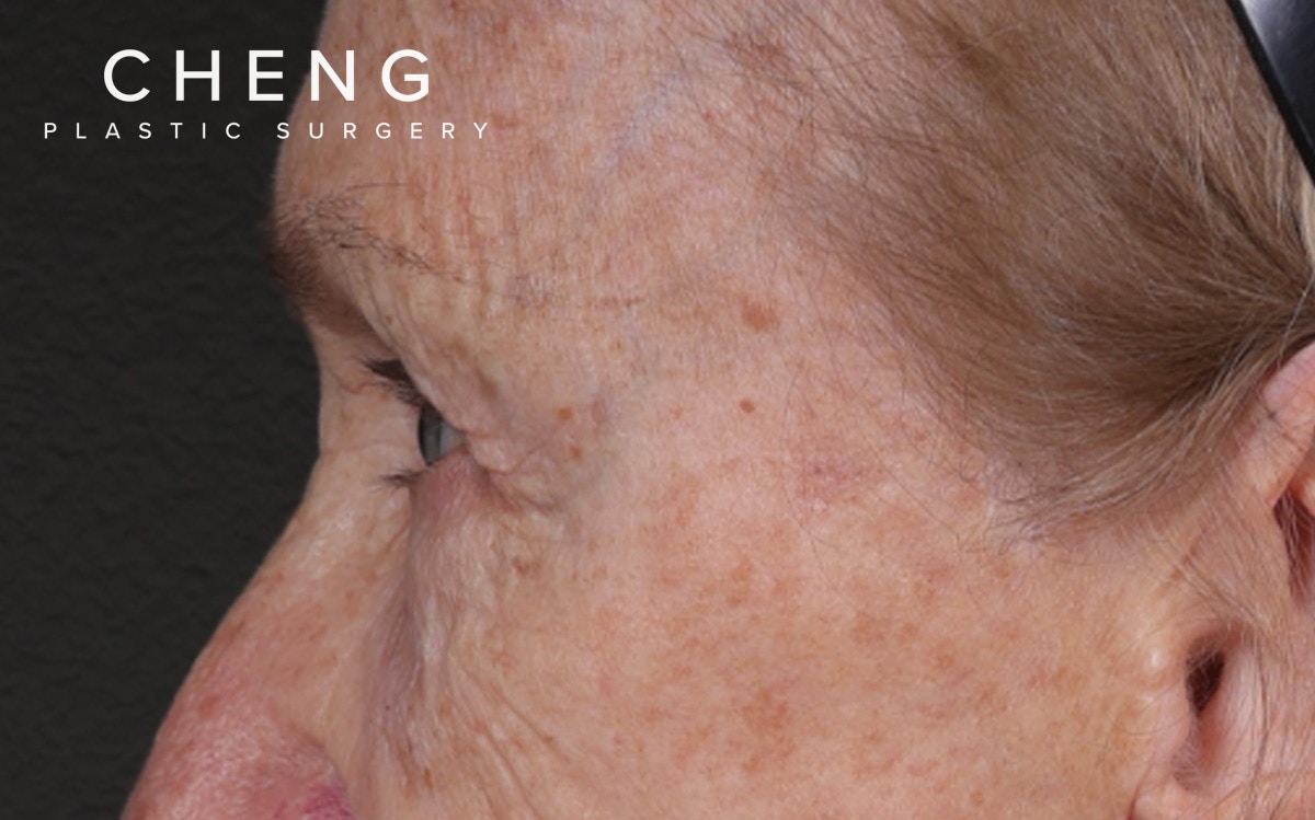 Blepharoplasty Before & After Gallery - Patient 162903 - Image 9
