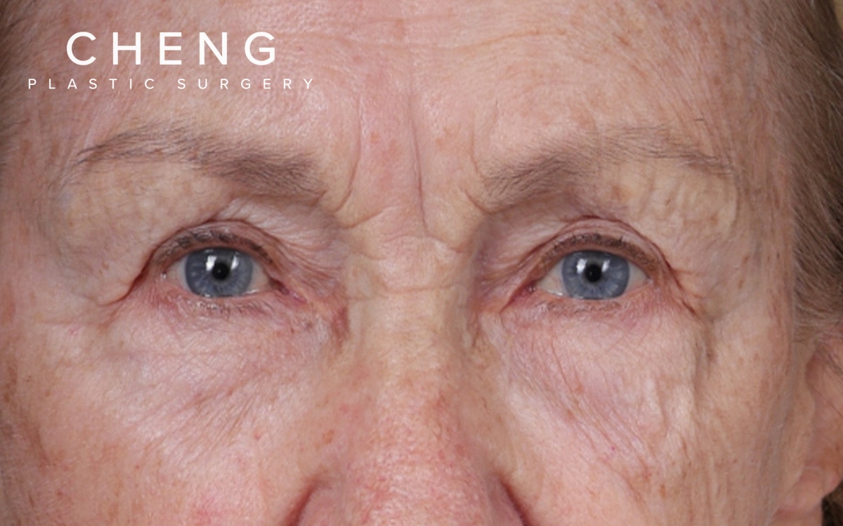 Blepharoplasty Before & After Gallery - Patient 162903 - Image 3