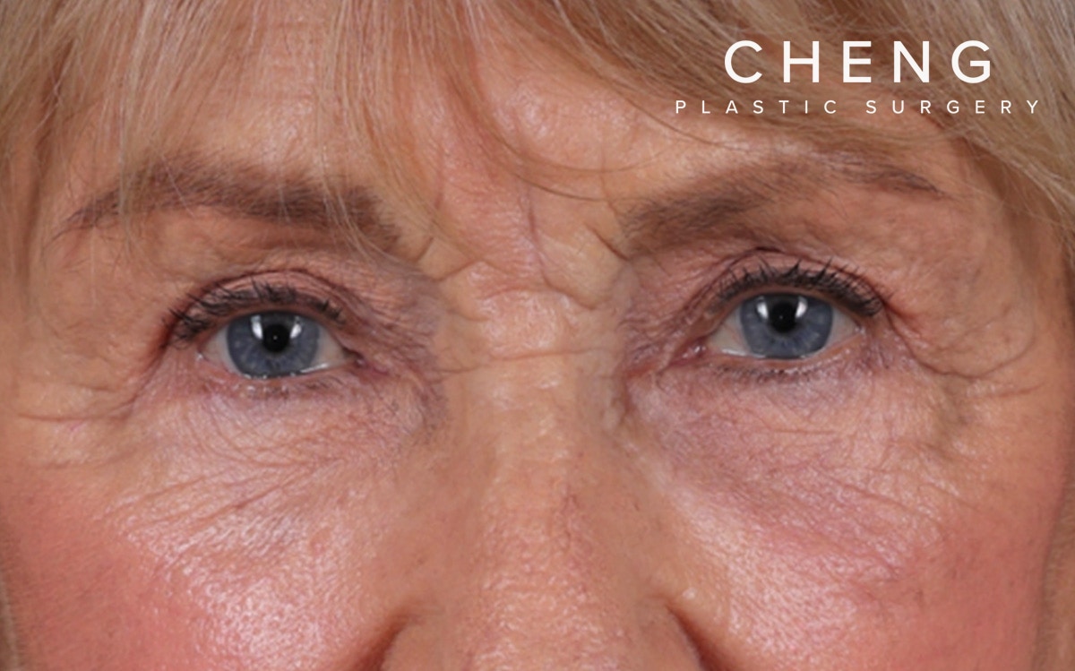 Blepharoplasty Before & After Gallery - Patient 162903 - Image 4
