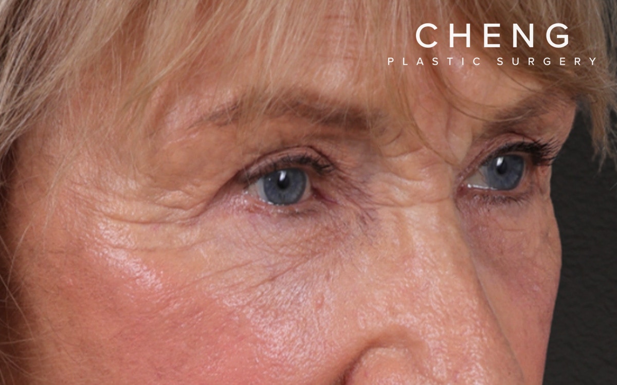 Blepharoplasty Before & After Gallery - Patient 162903 - Image 2