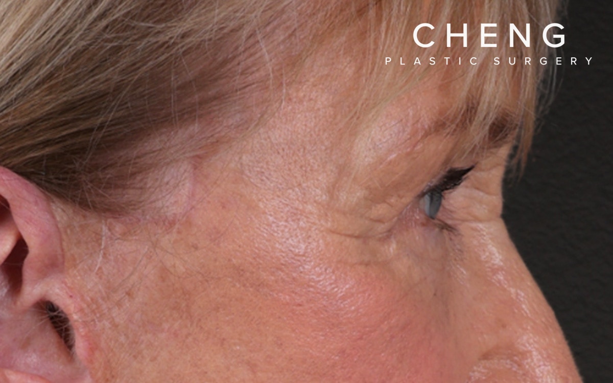 Blepharoplasty Before & After Gallery - Patient 162903 - Image 6