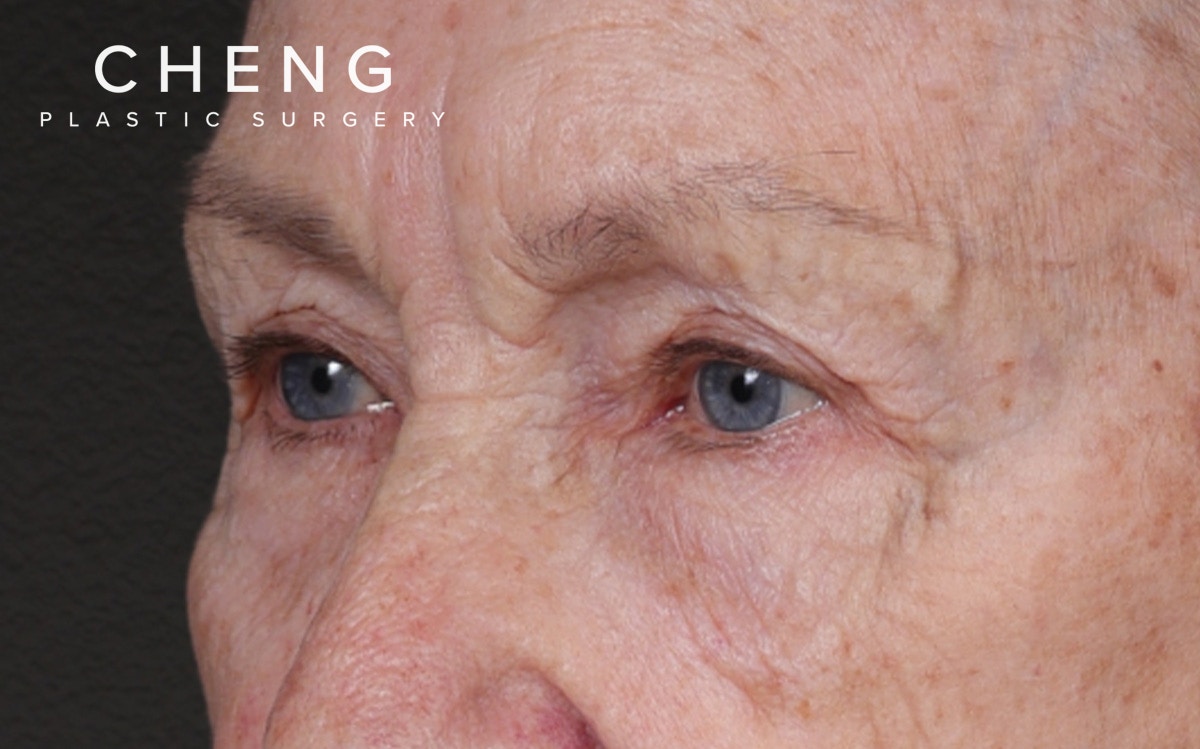 Blepharoplasty Before & After Gallery - Patient 162903 - Image 7