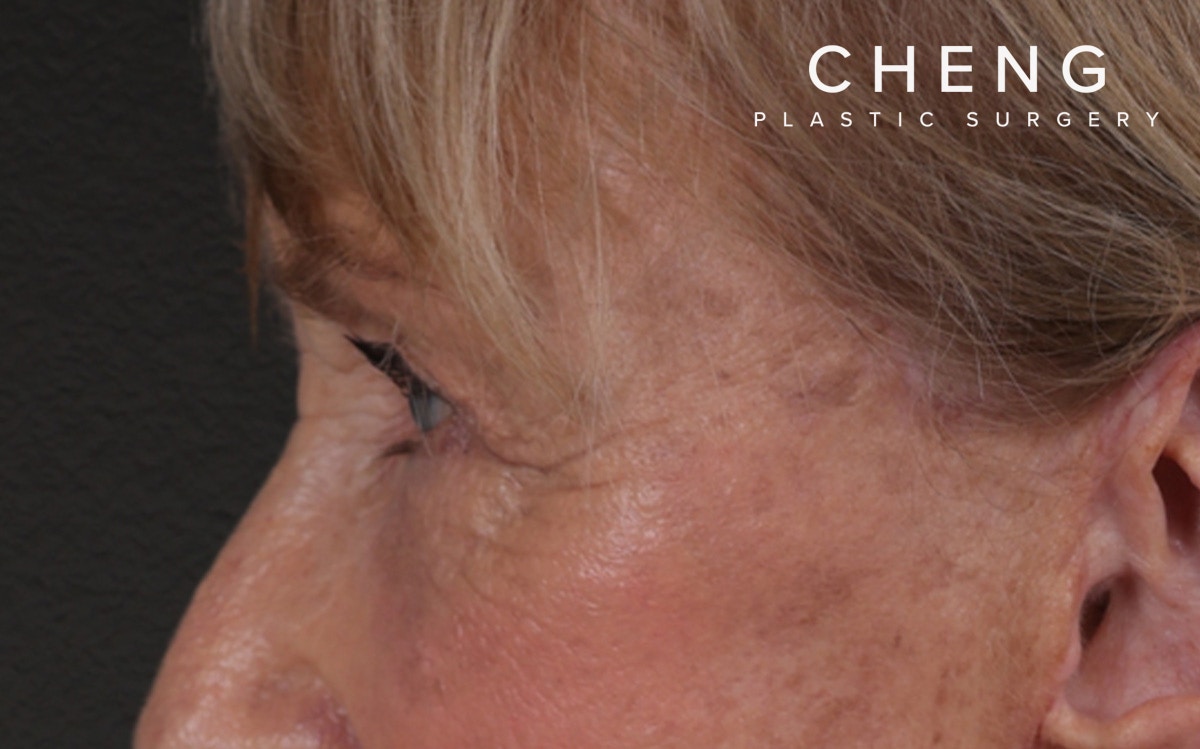 Blepharoplasty Before & After Gallery - Patient 162903 - Image 10