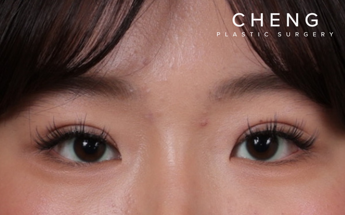 Blepharoplasty Before & After Gallery - Patient 308998 - Image 2