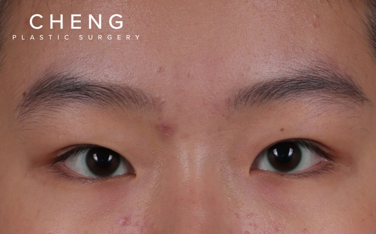 Blepharoplasty Before & After Gallery - Patient 308998 - Image 1