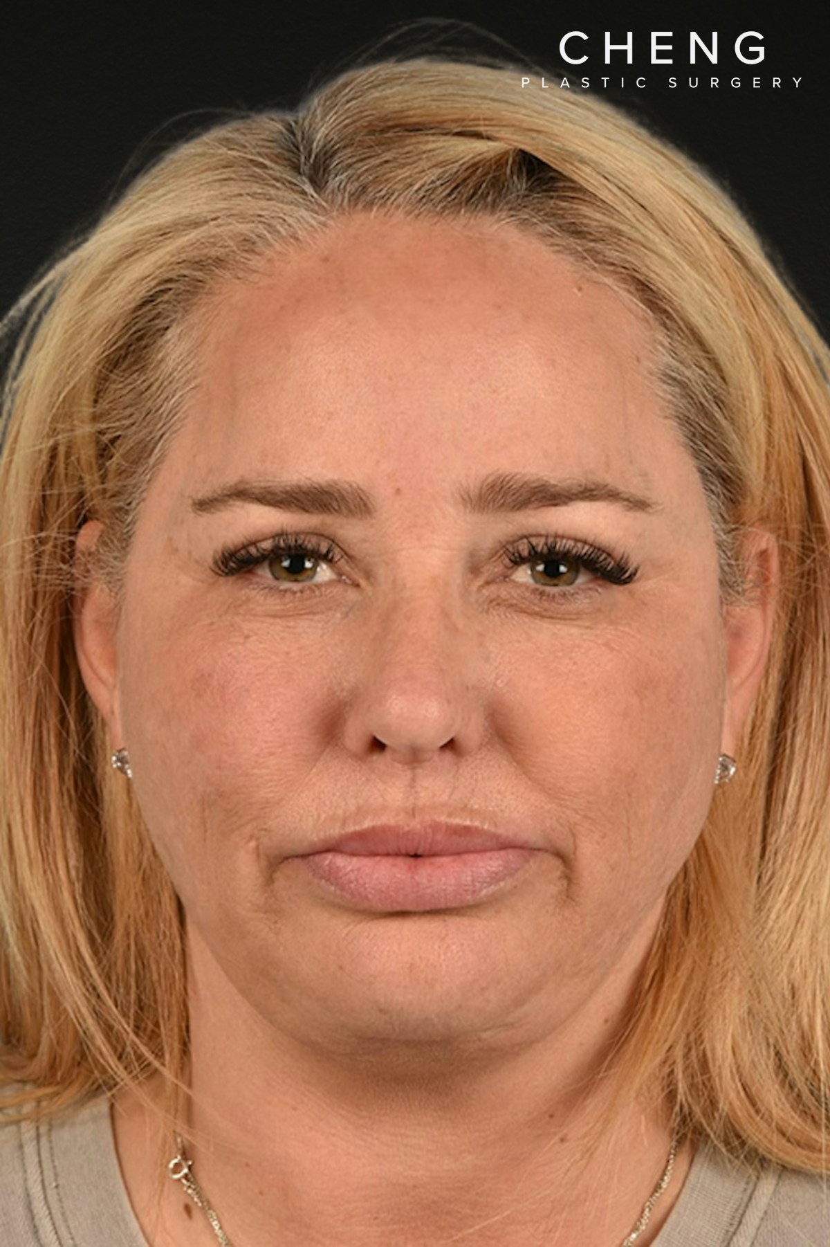 Renuvion Before & After Gallery - Patient 364740 - Image 2