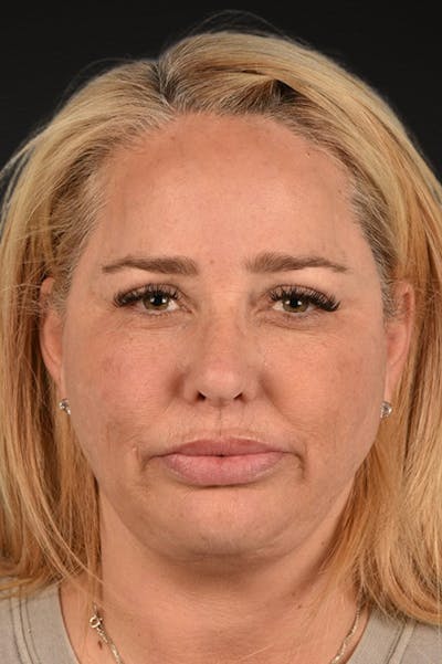 Renuvion Before & After Gallery - Patient 364740 - Image 2