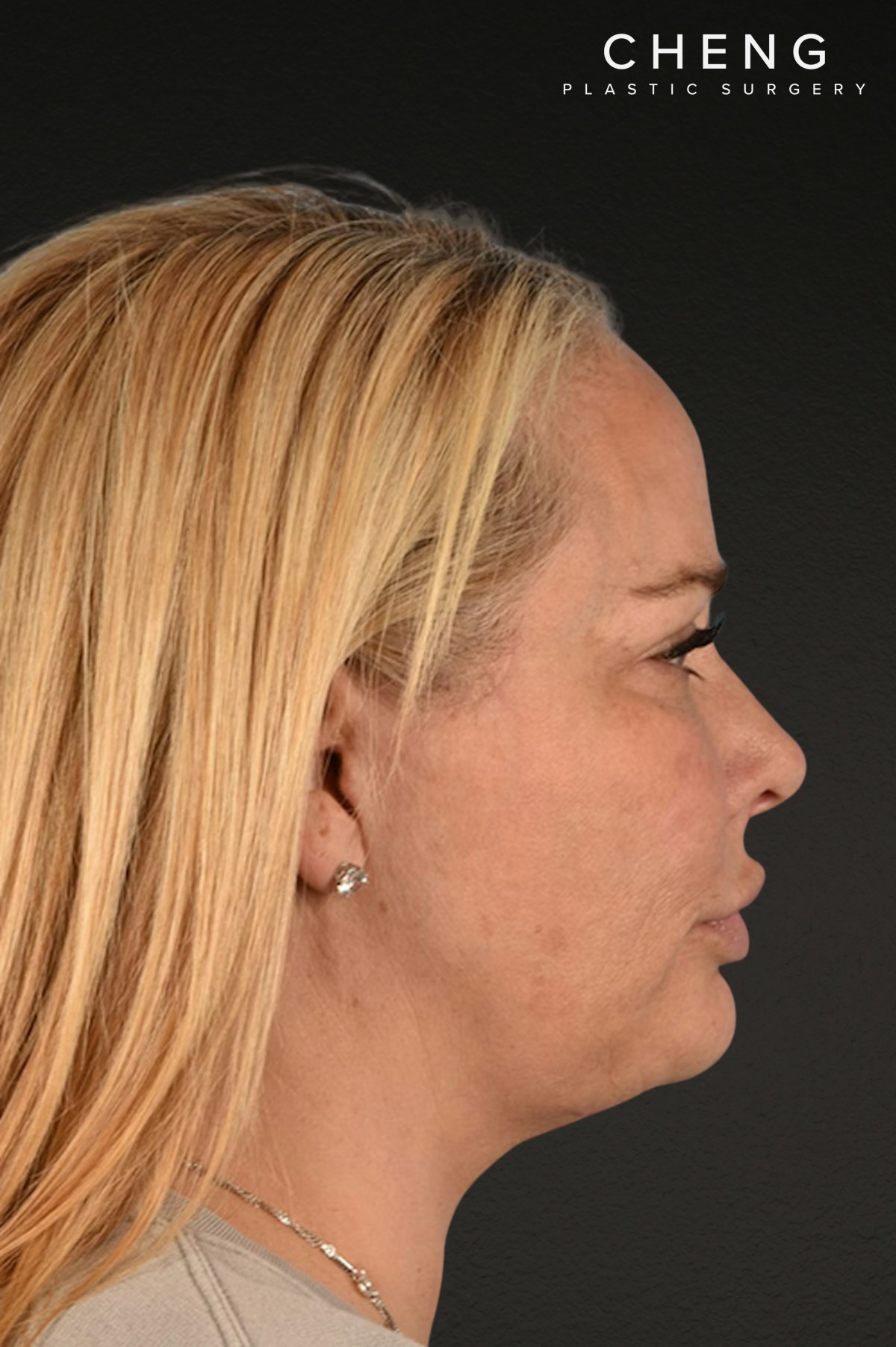 Renuvion Before & After Gallery - Patient 364740 - Image 8