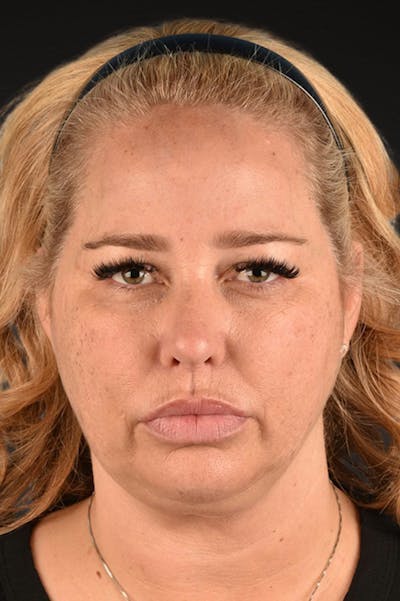 Renuvion Before & After Gallery - Patient 364740 - Image 1