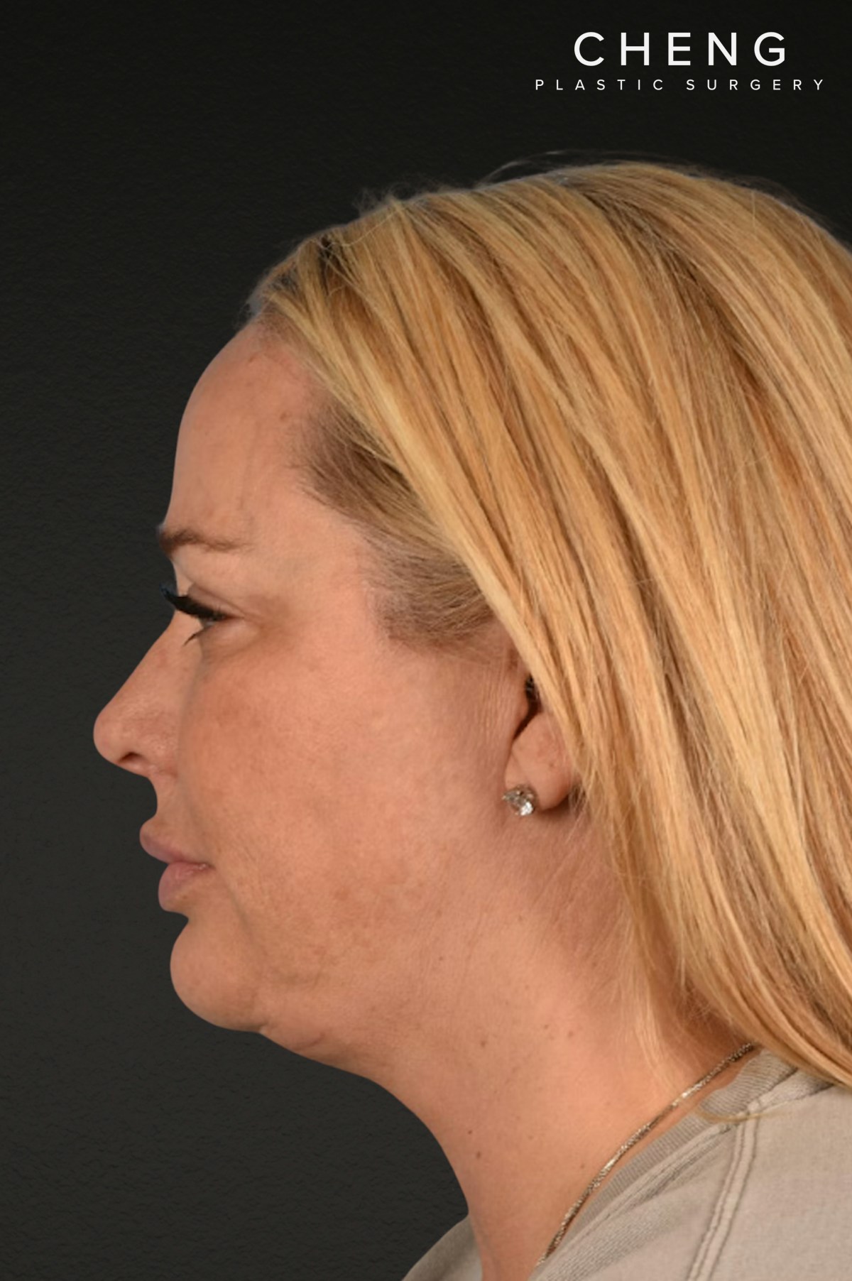Renuvion Before & After Gallery - Patient 364740 - Image 6