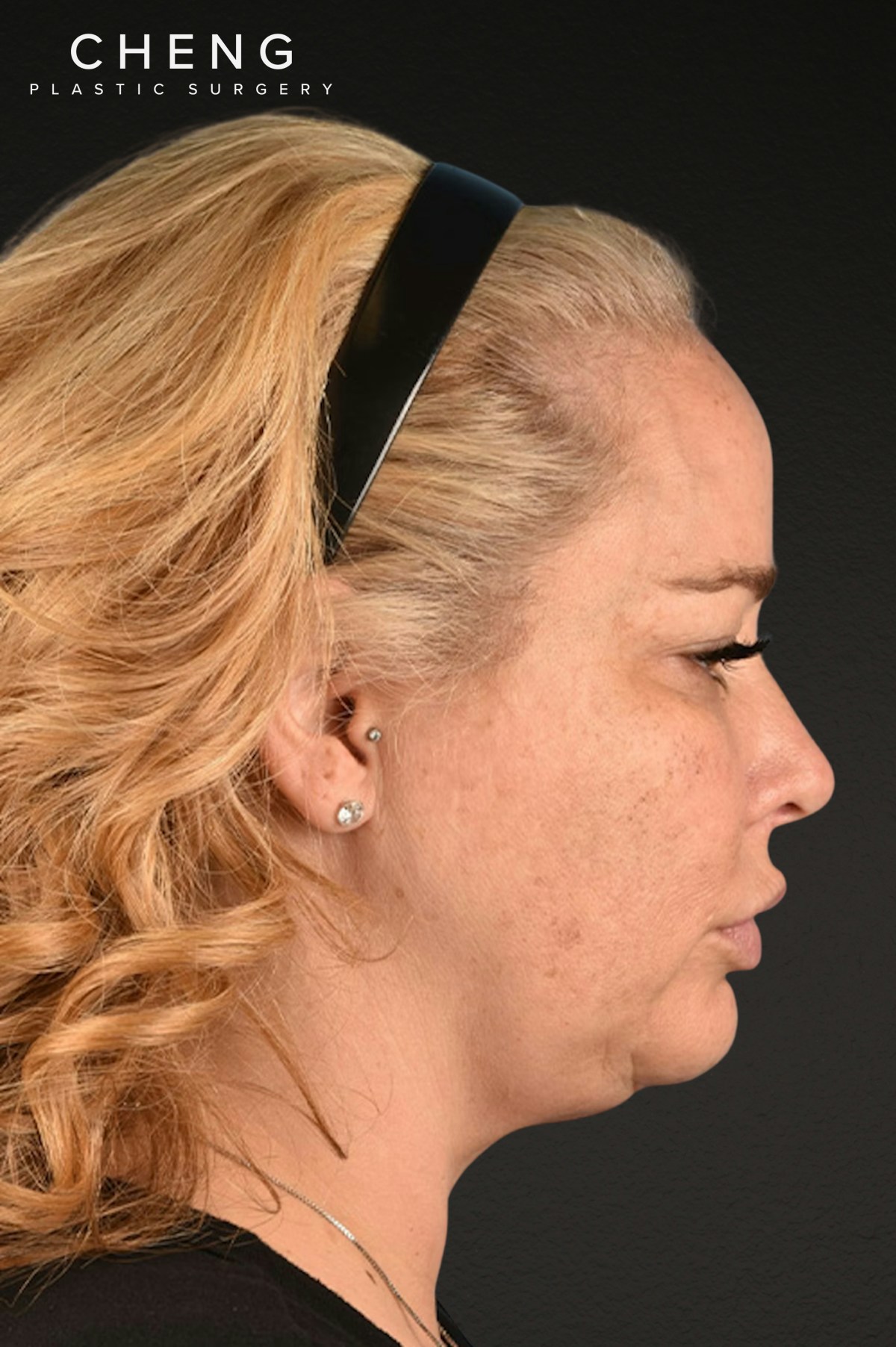 Renuvion Before & After Gallery - Patient 364740 - Image 7