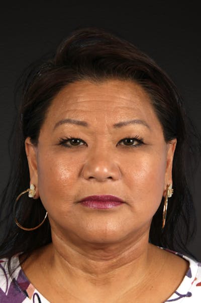 Renuvion Before & After Gallery - Patient 125918 - Image 2