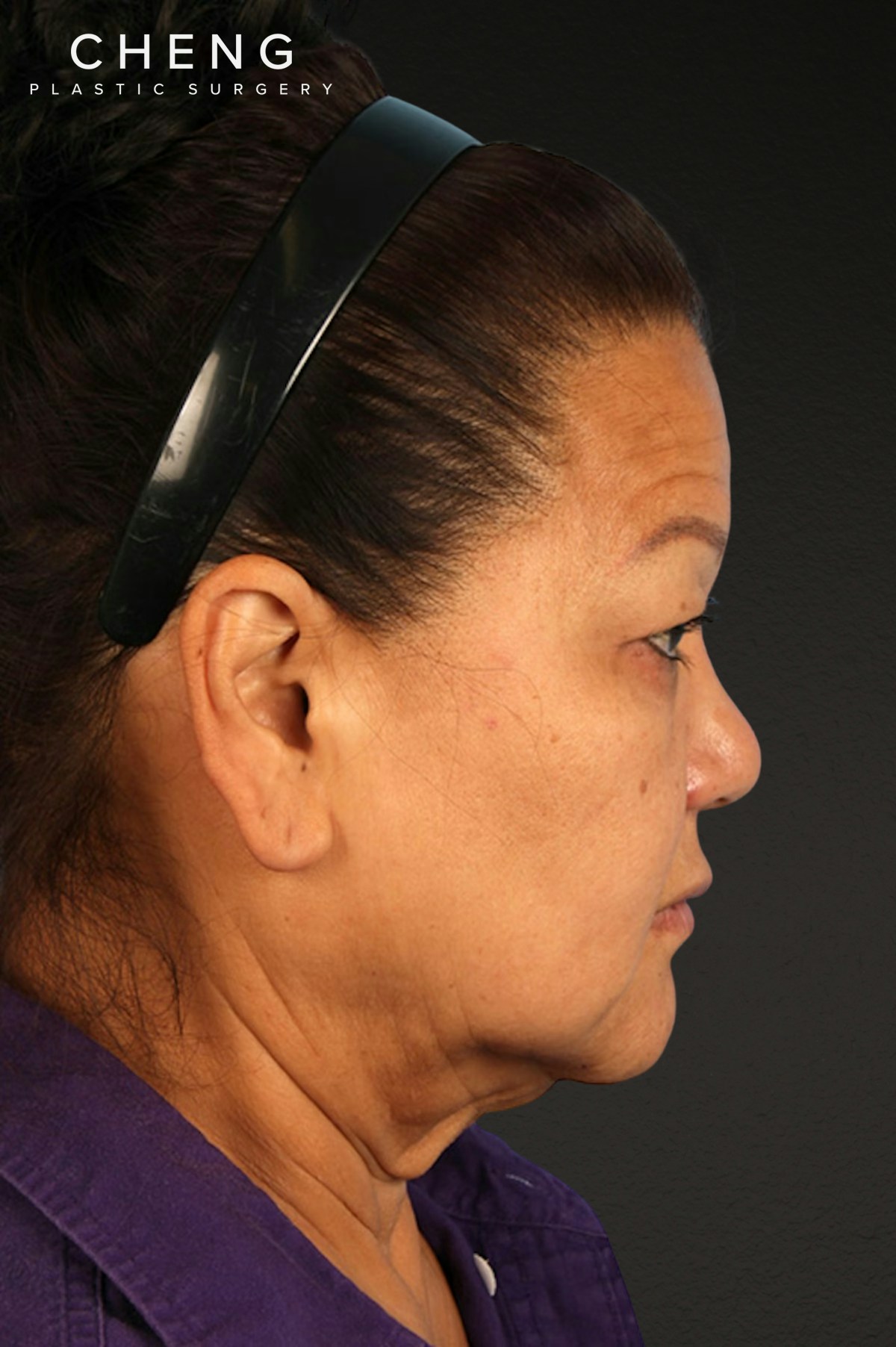 Renuvion Before & After Gallery - Patient 125918 - Image 3