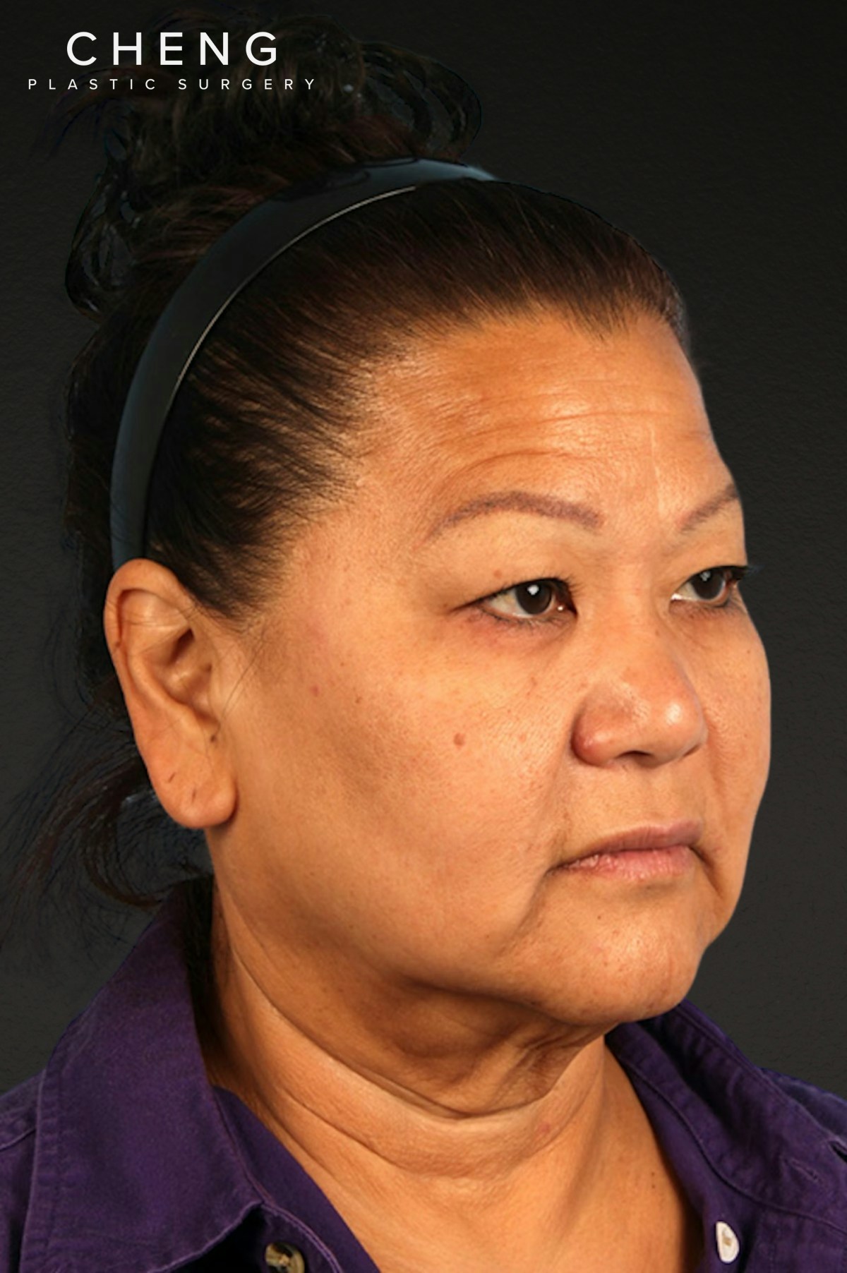 Renuvion Before & After Gallery - Patient 125918 - Image 7