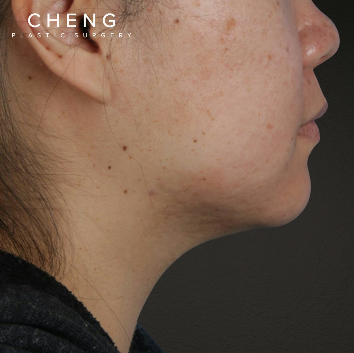 Renuvion Before & After Gallery - Patient 296884 - Image 3