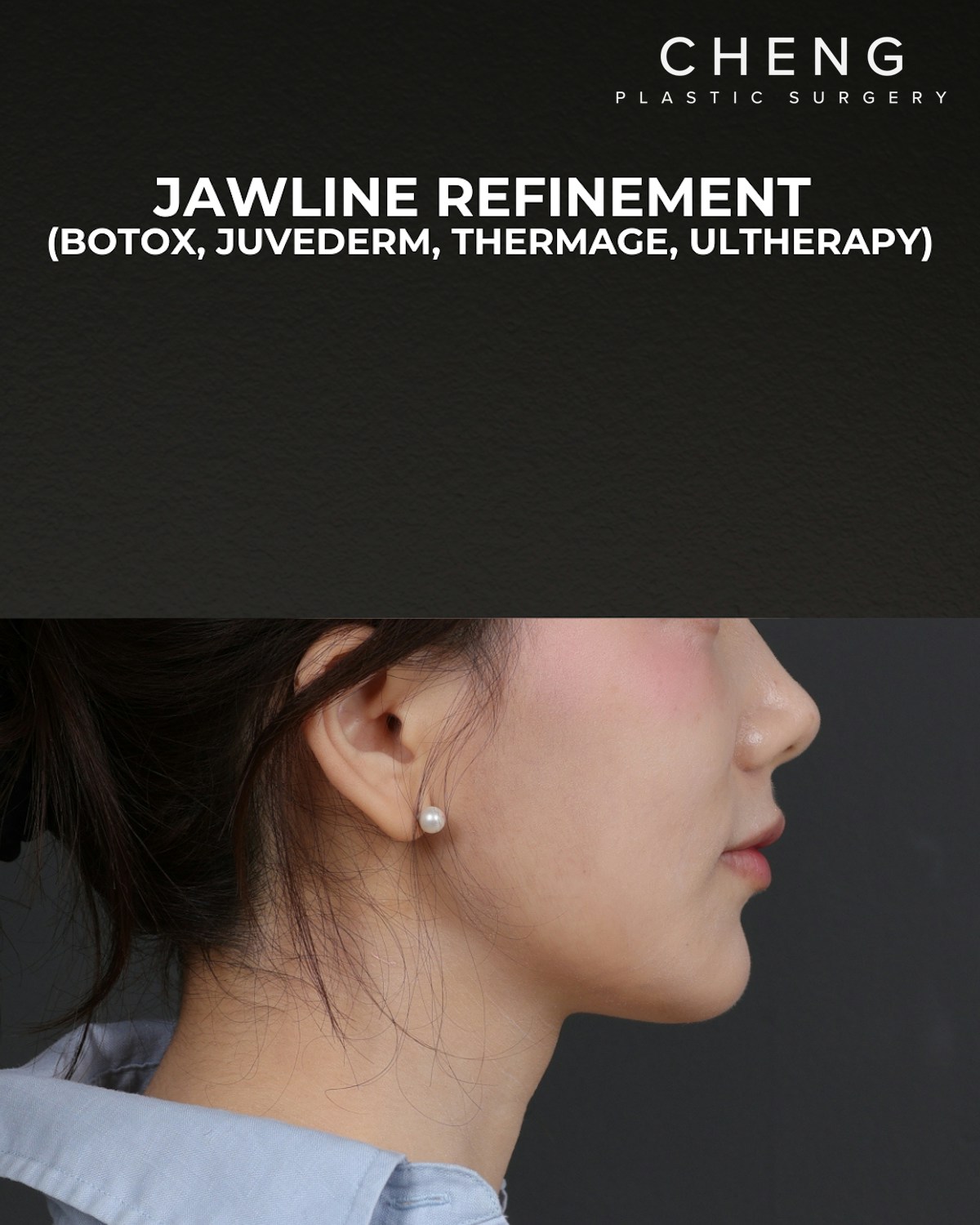 Dermal Fillers Before & After Gallery - Patient 320376 - Image 4