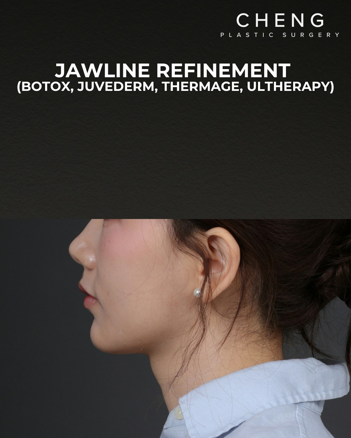 Dermal Fillers Before & After Gallery - Patient 320376 - Image 8